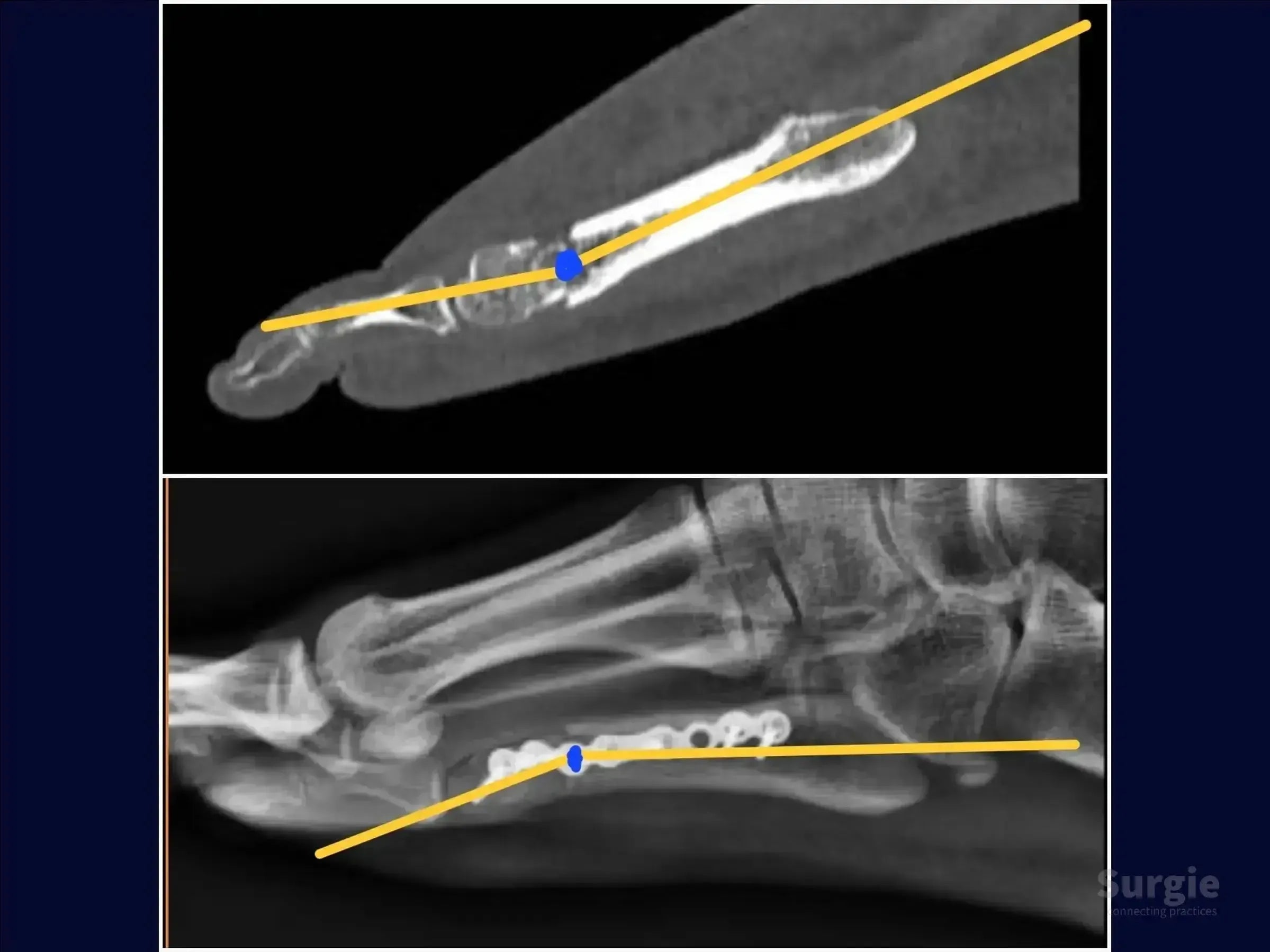 Radiographic comparison of a fifth metatarsal fracture before and after surgical fixation with a locked plate and screws.