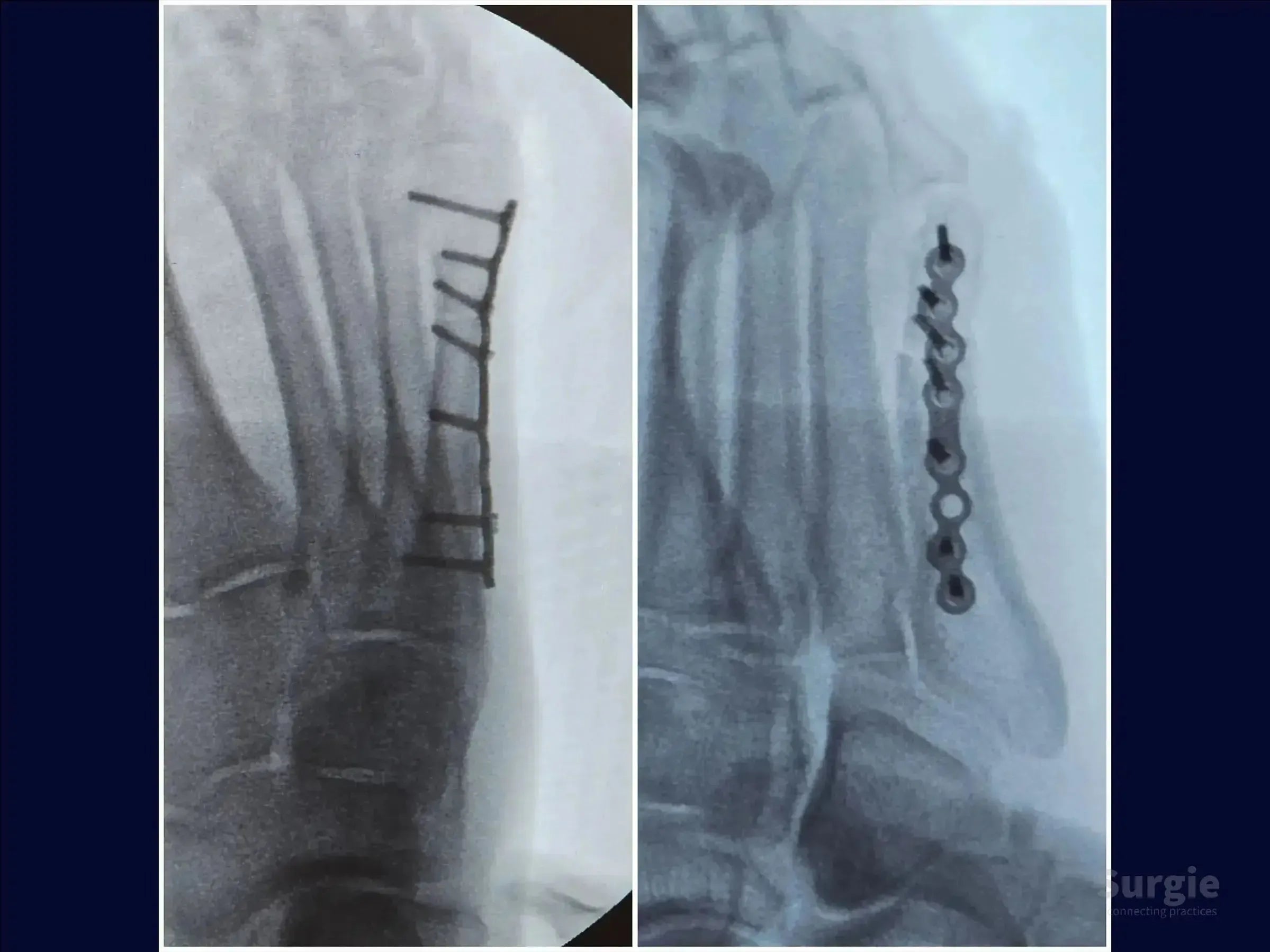X-ray showing a fifth metatarsal fracture fixed with a metal locking plate and screws for anatomical reduction.