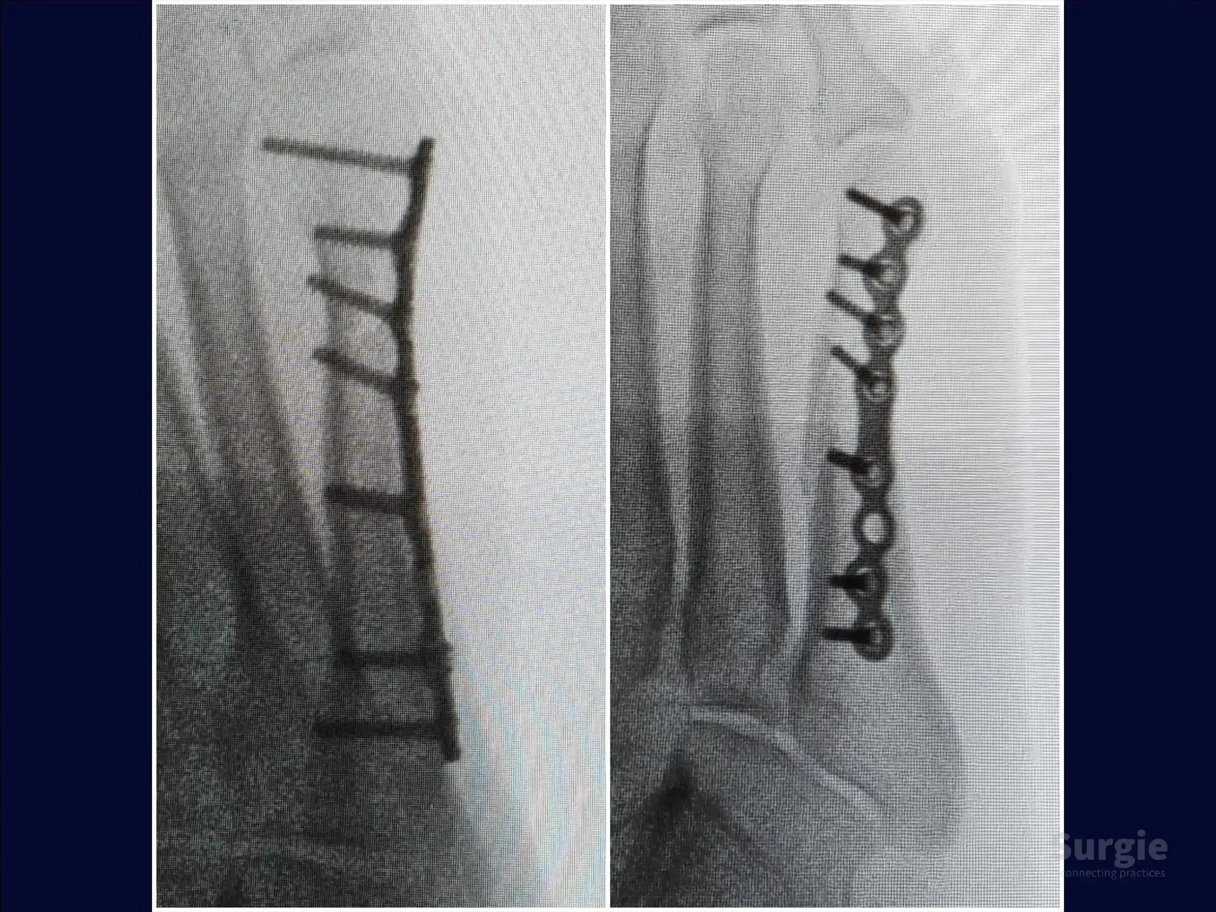 X-ray showing a fifth metatarsal fracture stabilized with a metal locked plate and multiple screws in two views.