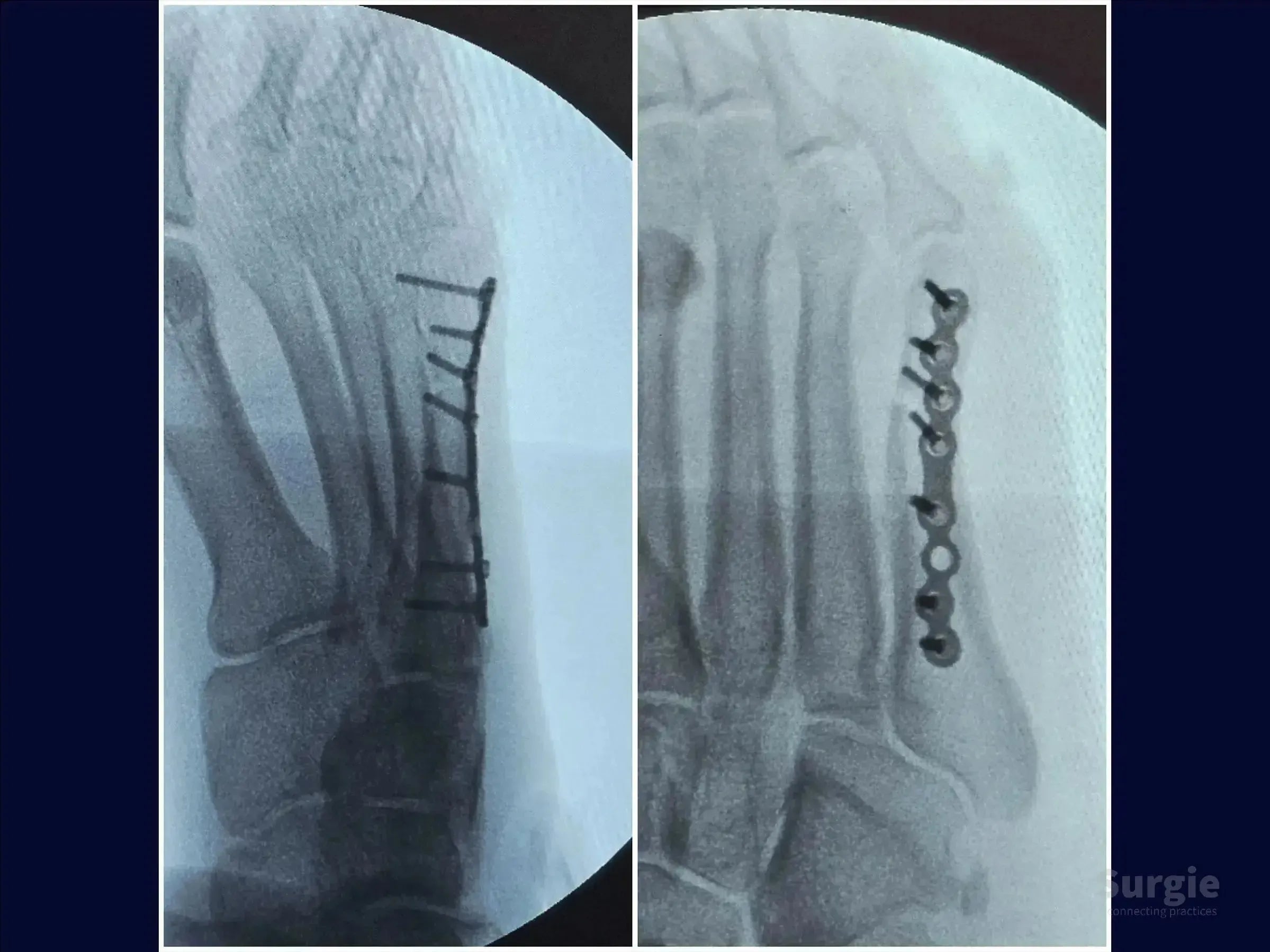 X-ray showing a fifth metatarsal fracture fixed with a metallic locked plate and screws for anatomical alignment.
