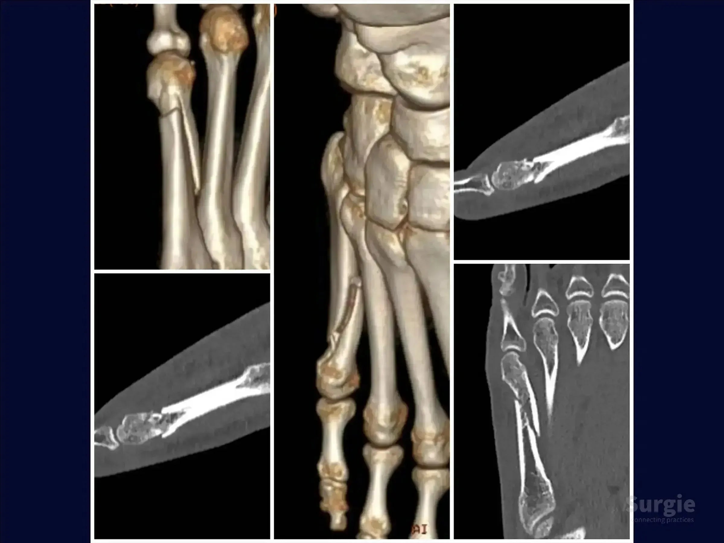 3D CT scan showing a displaced fifth metatarsal fracture with multiple views of the bone structure and alignment.