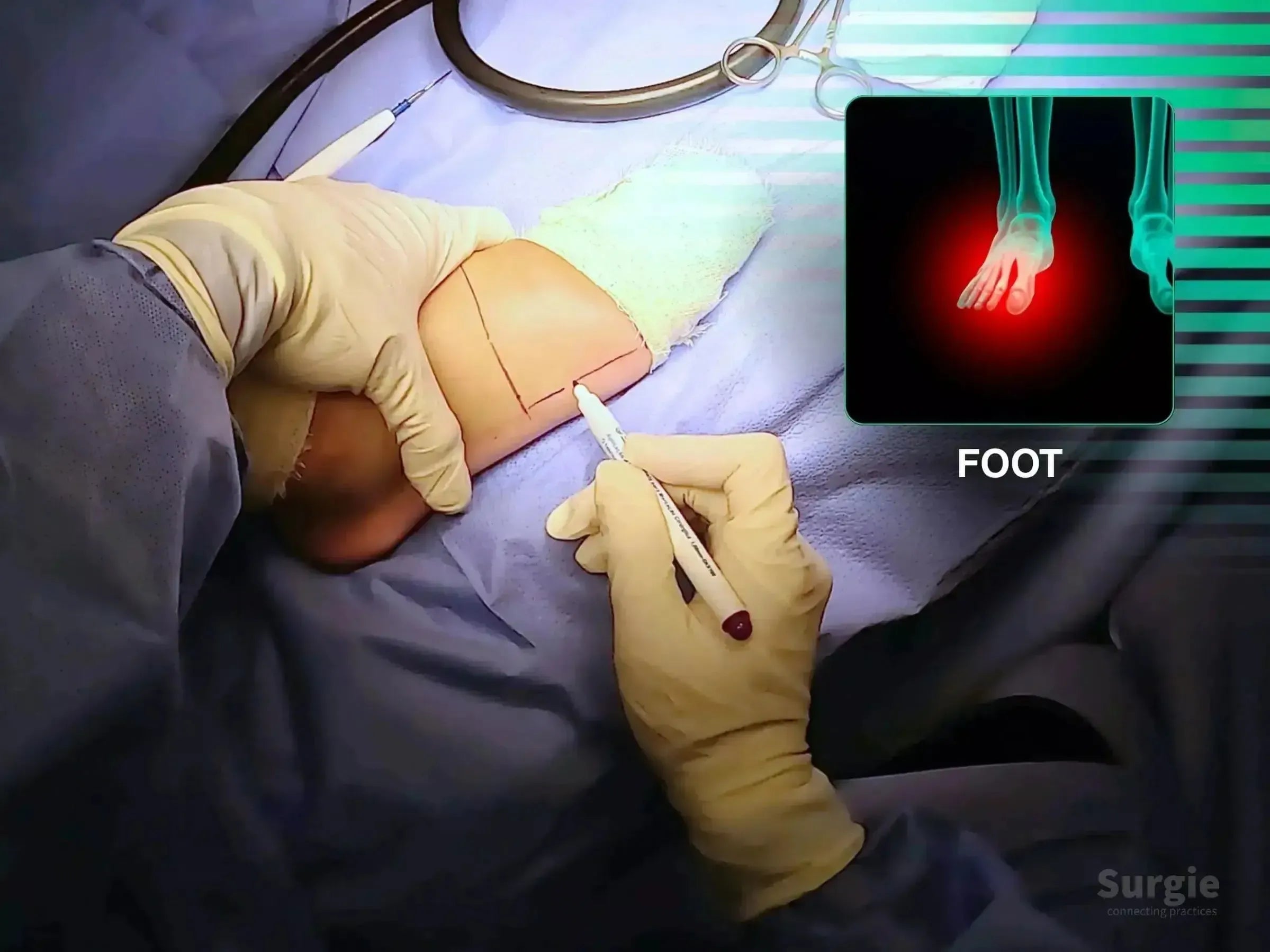 Surgeon marking a fifth metatarsal incision site on a patient's foot with an anatomical reference overlay.