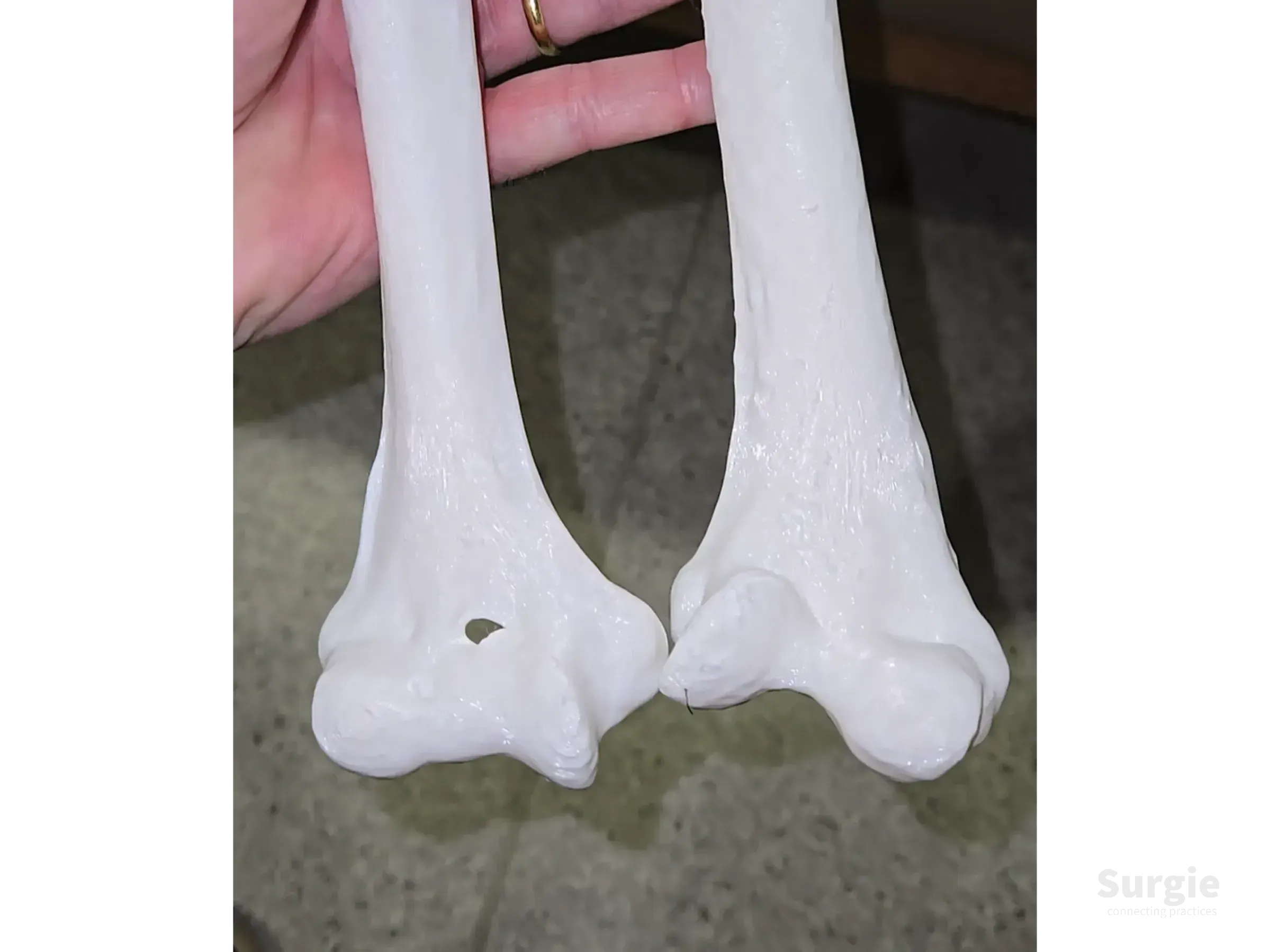 White 3D-printed distal humerus bone models for orthopedic osteotomy planning and surgical training.