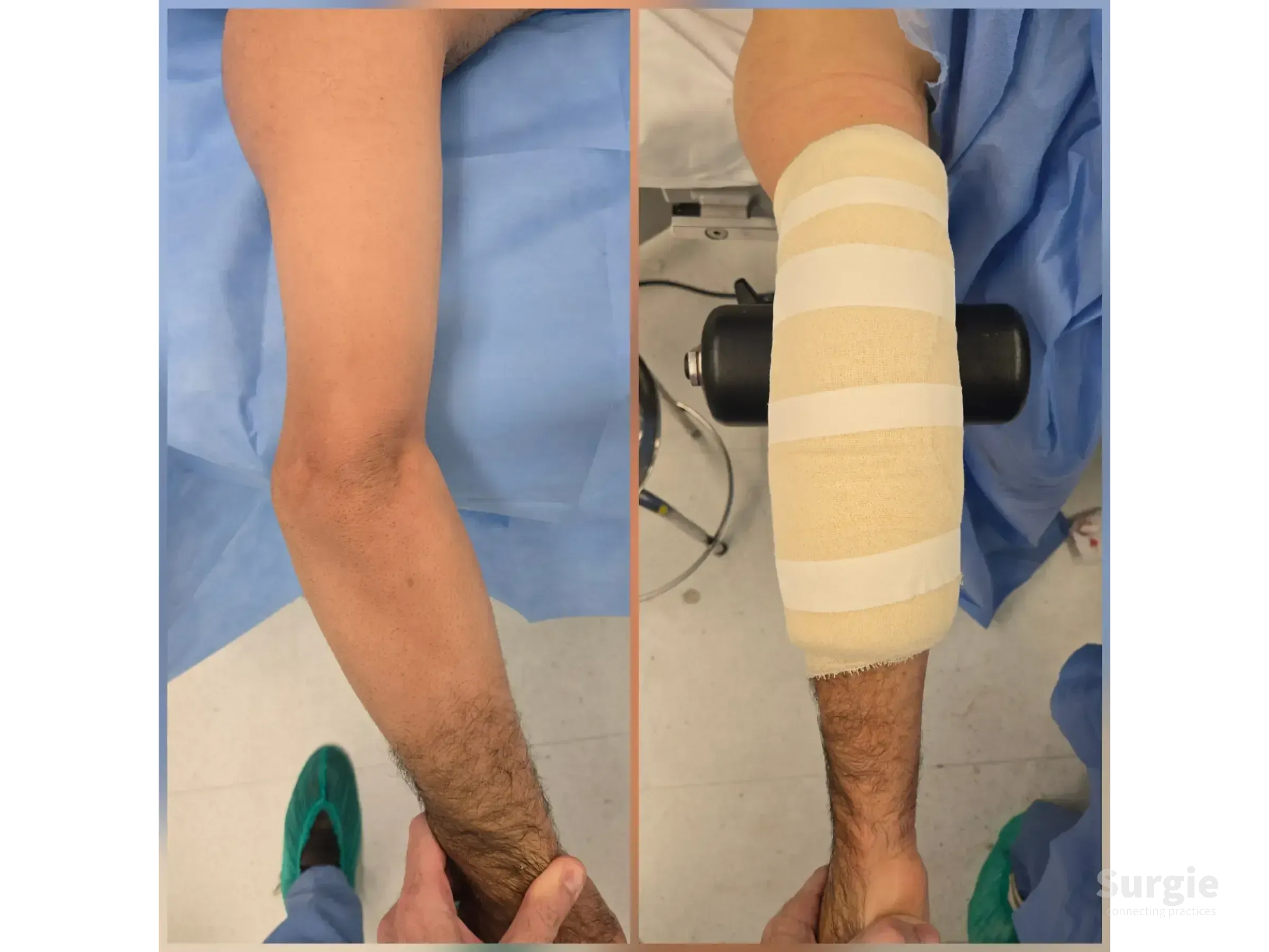 Comparison of a cubitus varus deformity before and after surgical dressing on a patient's arm in a clinical setting.