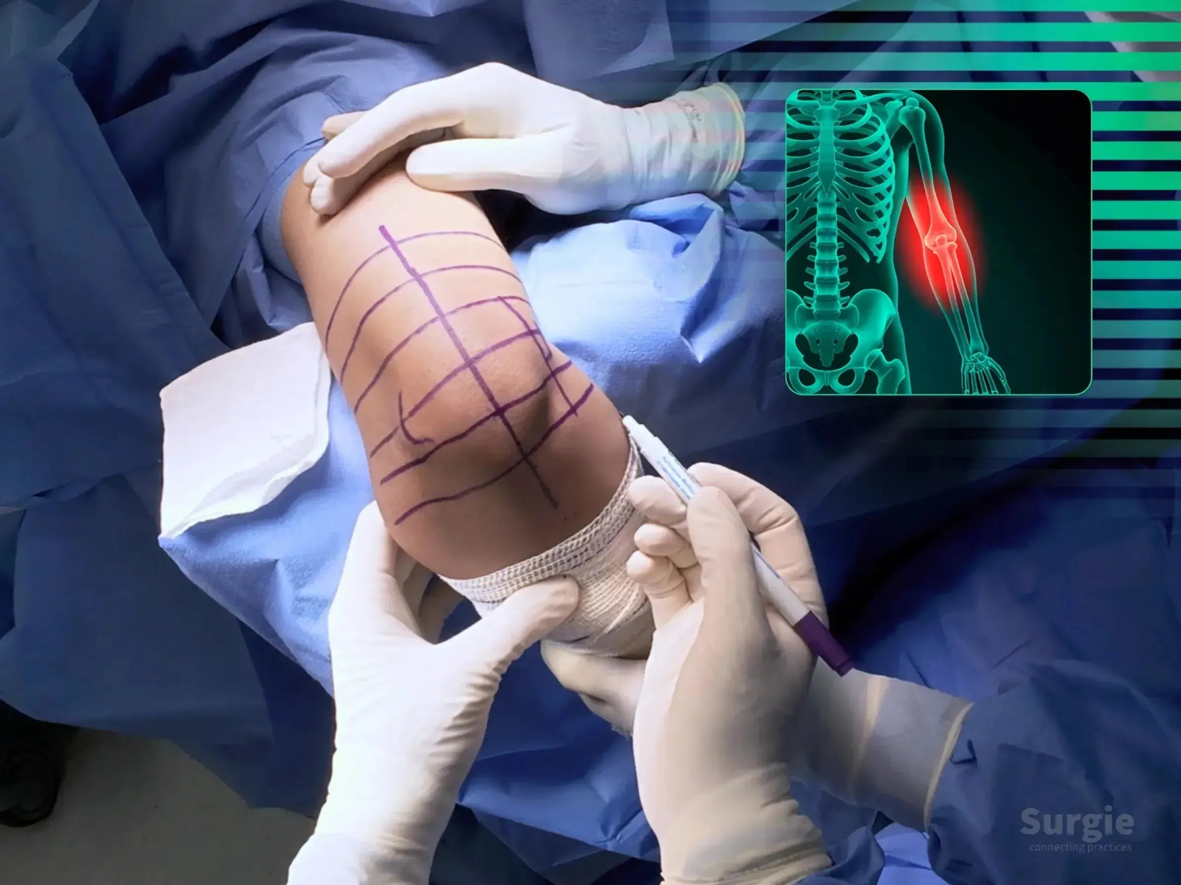 Surgeon marking a patient's elbow for distal humerus osteotomy with a digital skeletal overlay showing the humerus area.