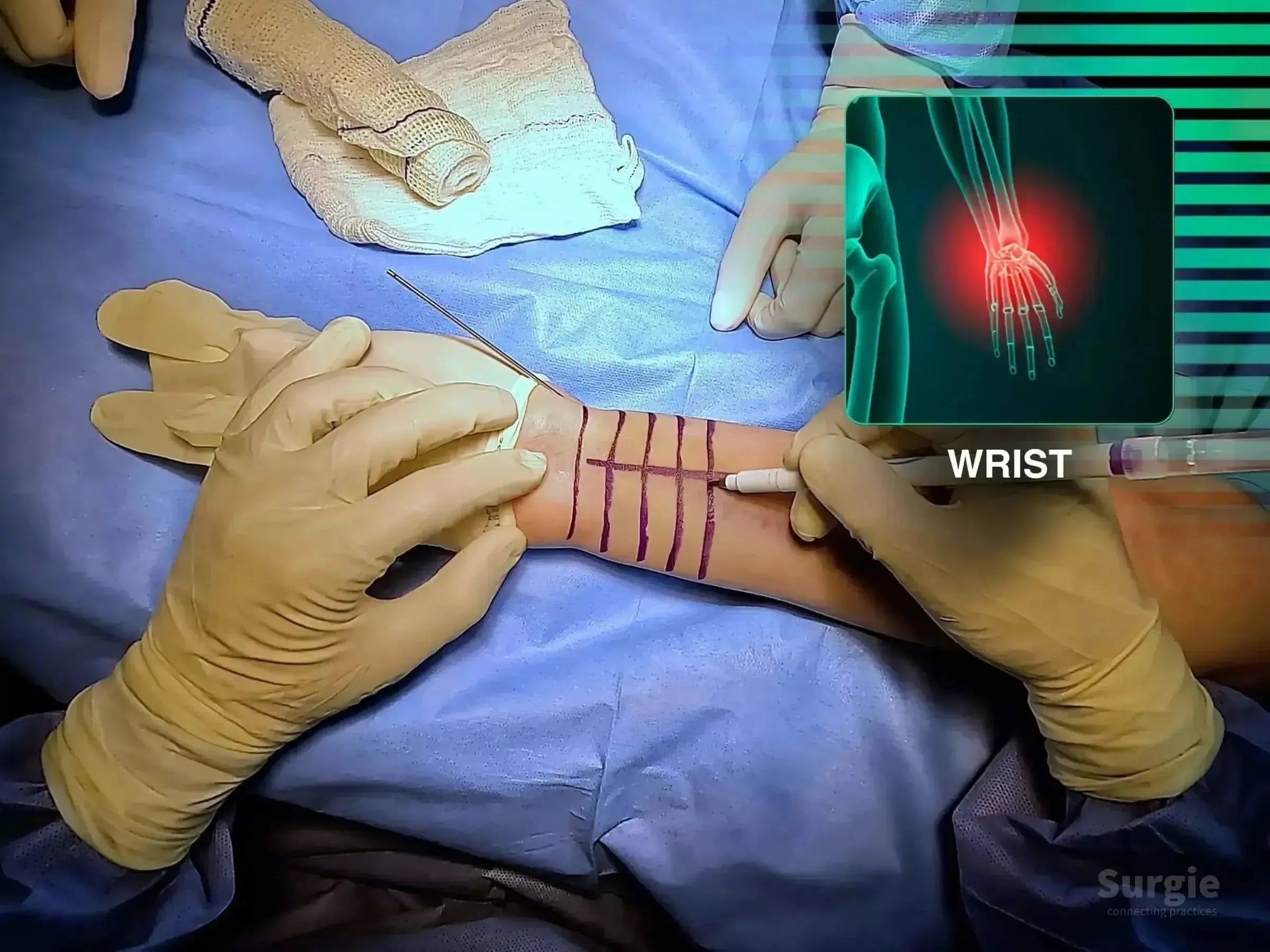 Surgeon marking a patient's wrist for a volar approach surgery with an anatomical X-ray overlay showing a fracture.