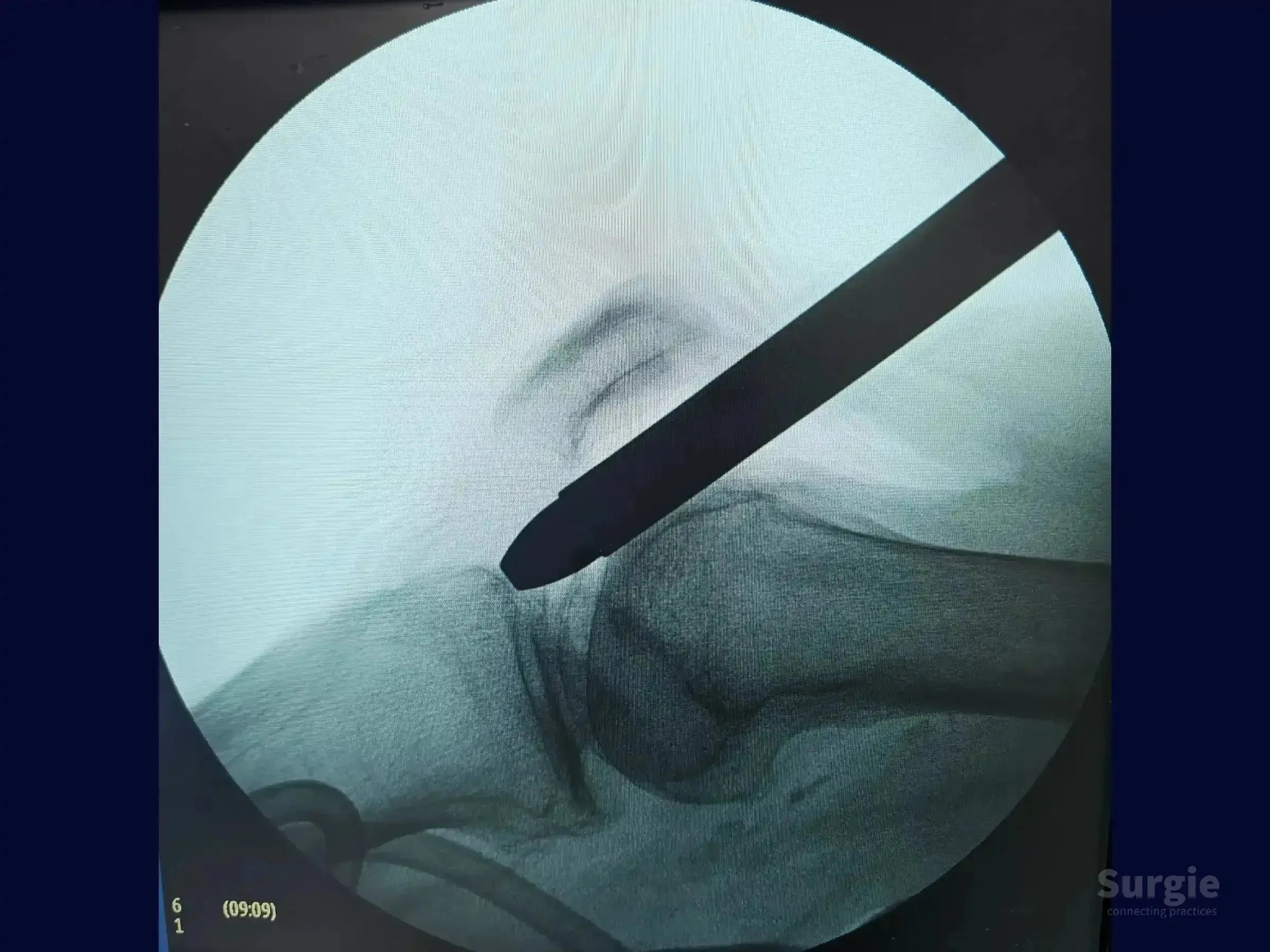 Fluoroscopic view of a metallic intramedullary nail inserted into the tibia via a suprapatellar approach.