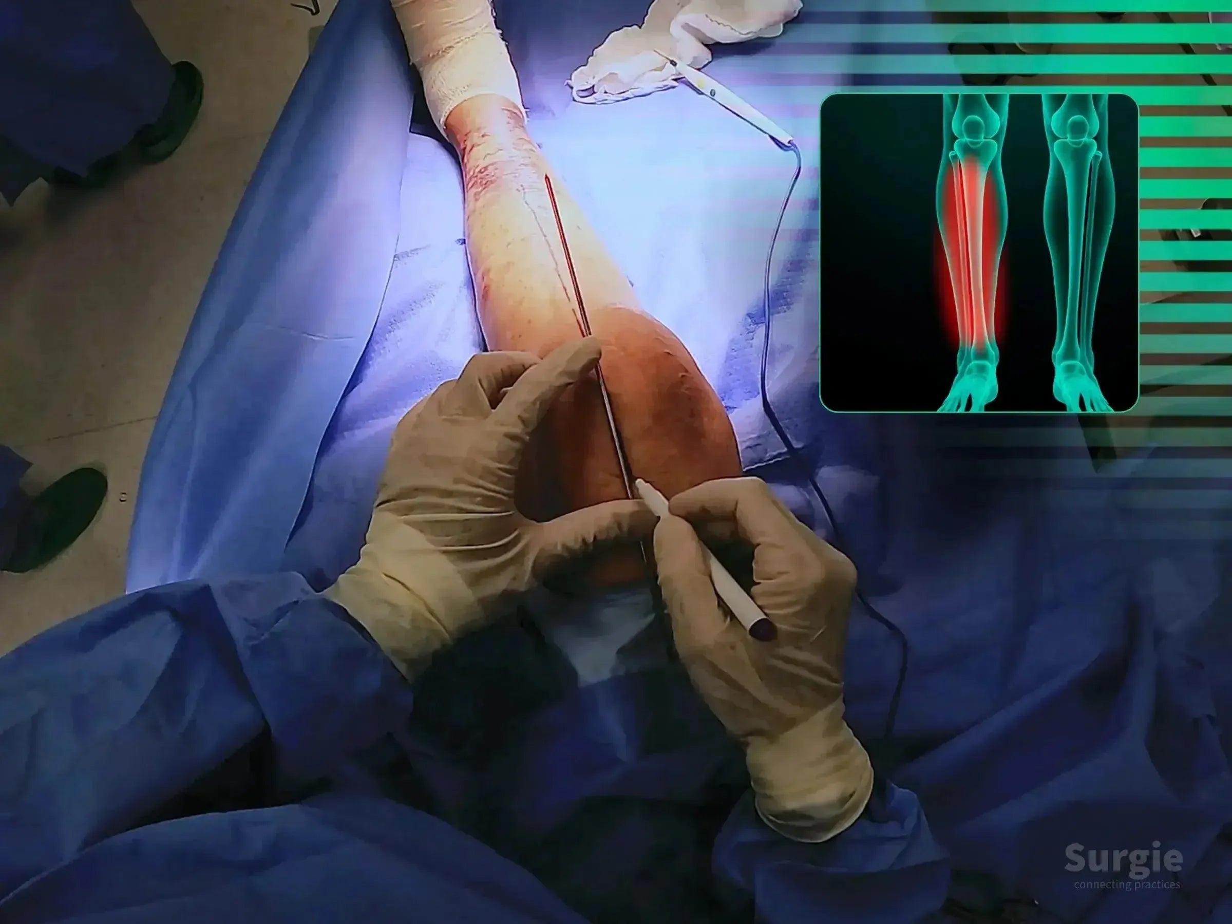 Surgeon marking a suprapatellar portal on a patient's leg for tibial intramedullary nail surgery with an X-ray overlay.
