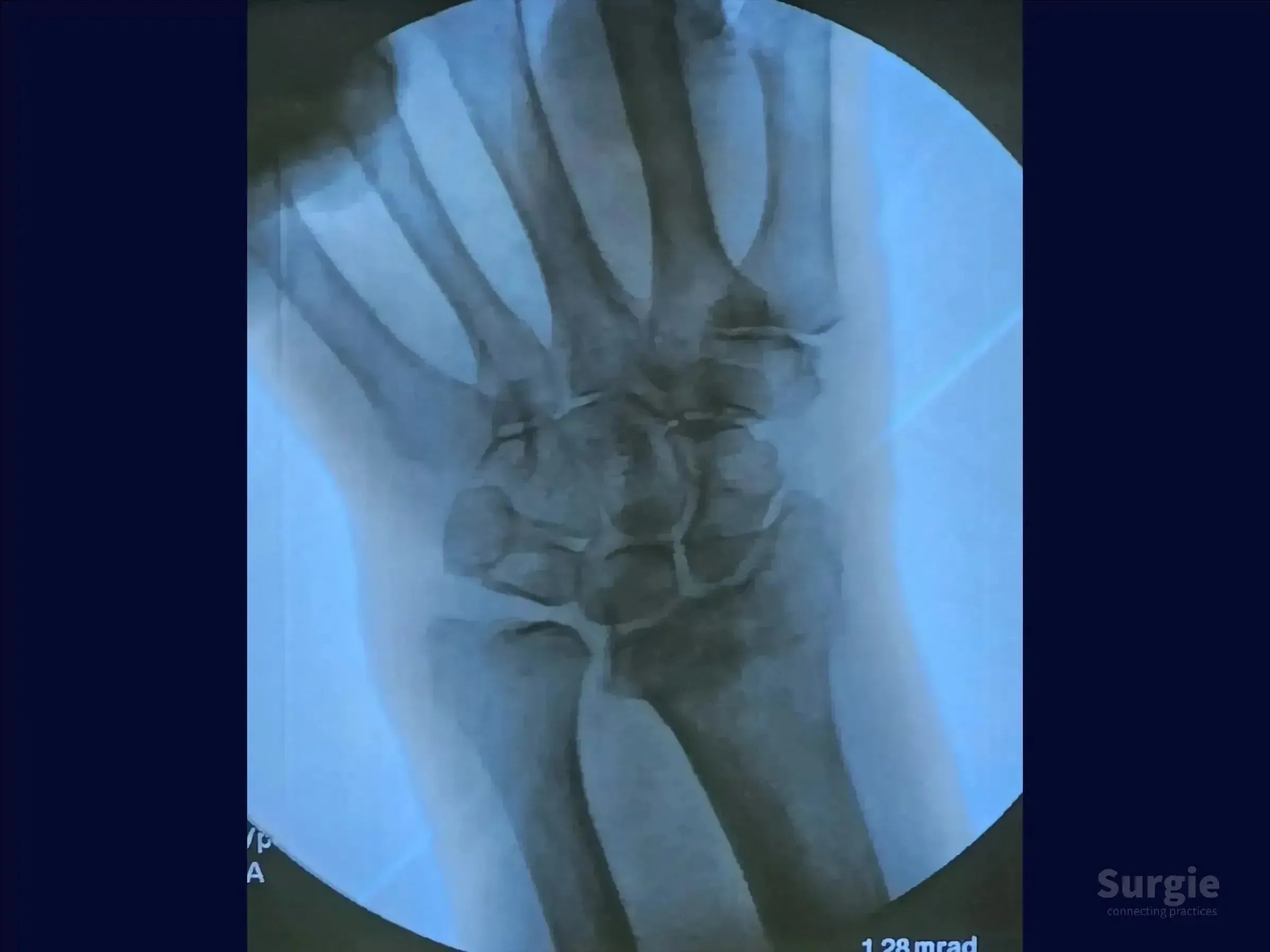 Grayscale X-ray showing a dorsal Barton's fracture of the radius with articular displacement of the wrist bones.