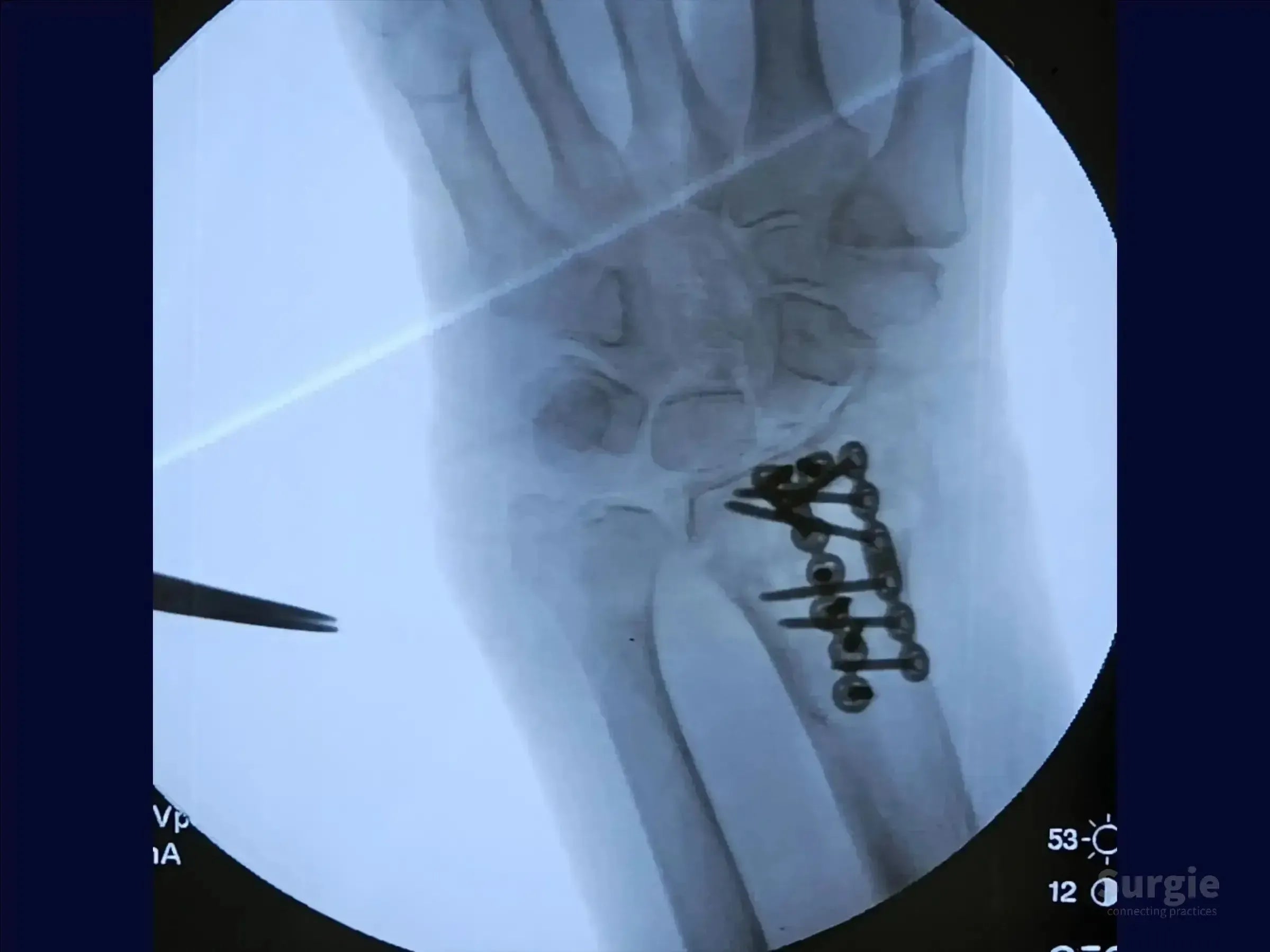 X-ray showing a metal plate and screws fixating a dorsal Barton's fracture of the radius in a human wrist.