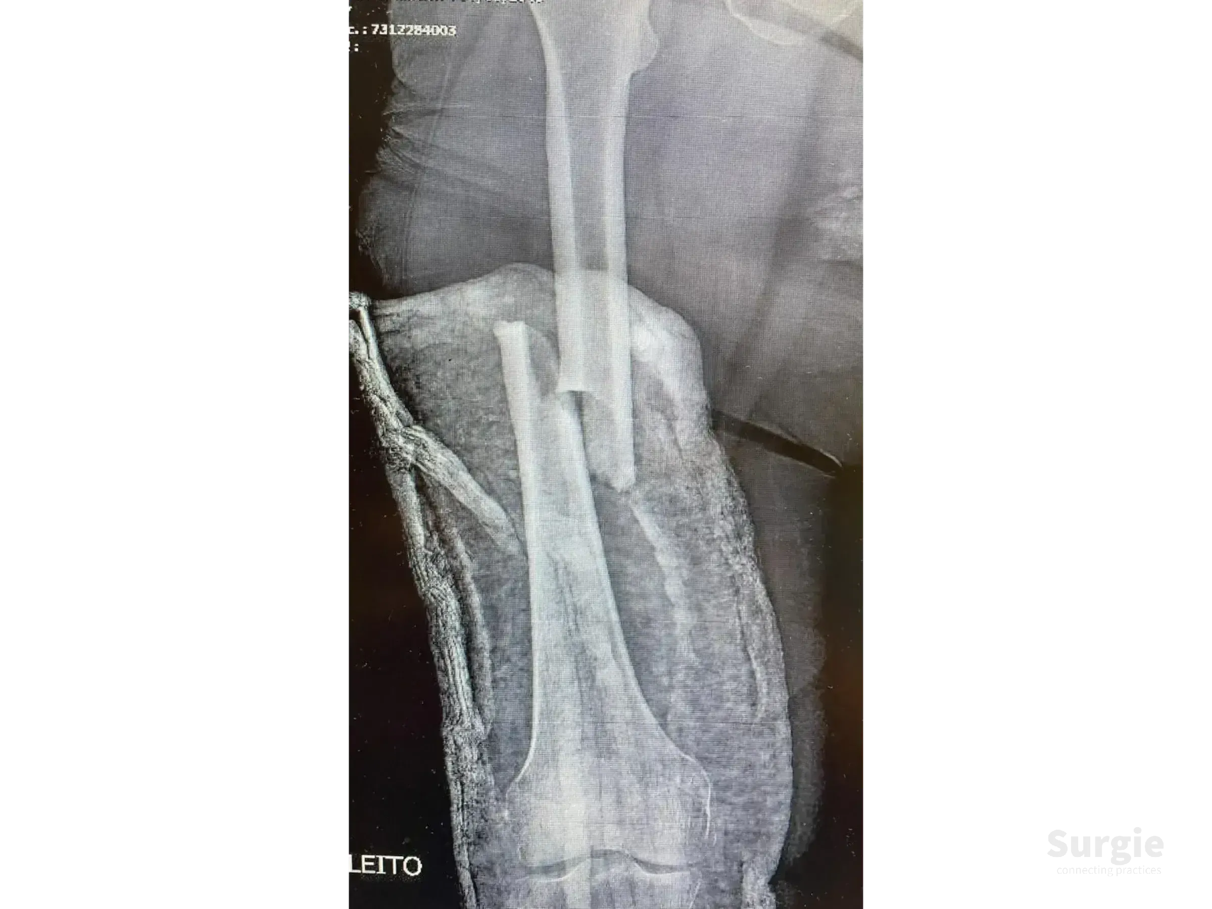 X-ray showing a displaced femoral shaft fracture with significant bone misalignment and soft tissue shadow.