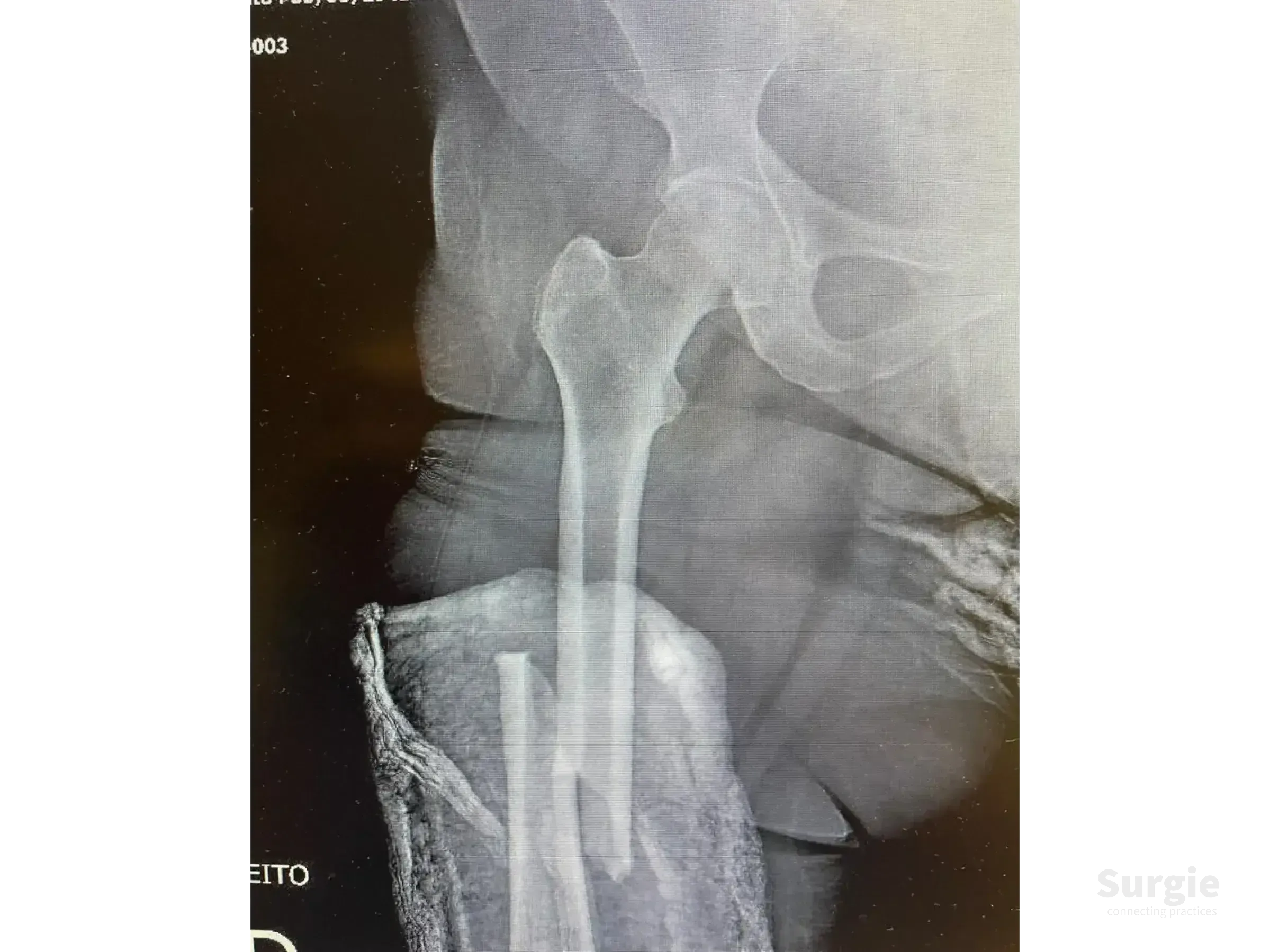 X-ray showing a femoral shaft fracture with cortical displacement, suitable for retrograde intramedullary nail planning.
