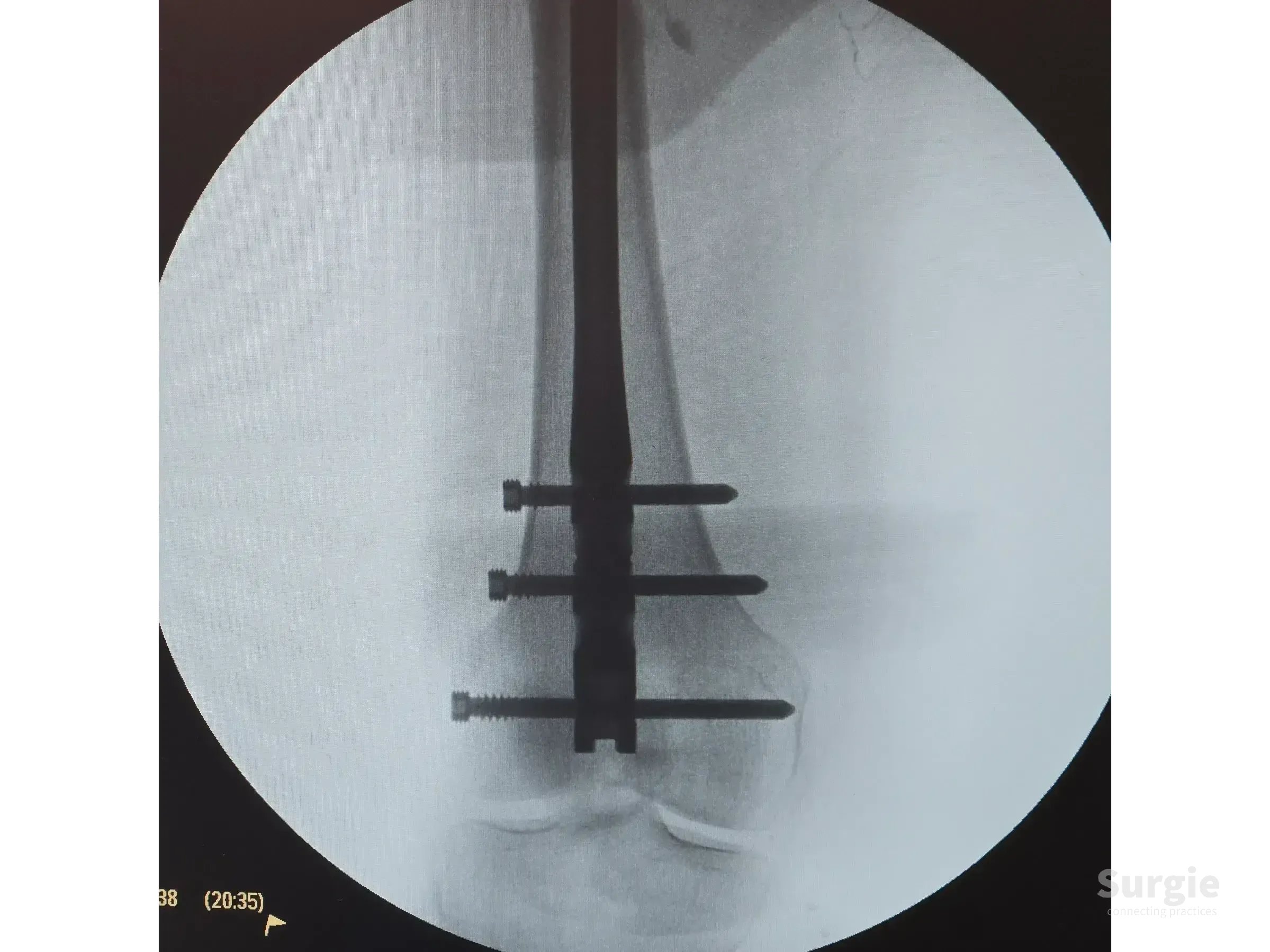 Fluoroscopic view of a retrograde intramedullary nail in a femoral shaft with three distal locking screws in place.