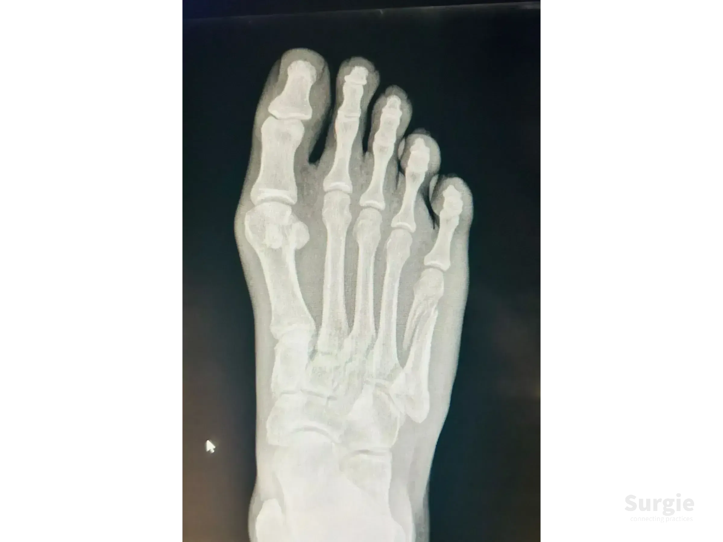 X-ray of a human foot showing a displaced fracture of the fifth metatarsal bone before surgical stabilization.