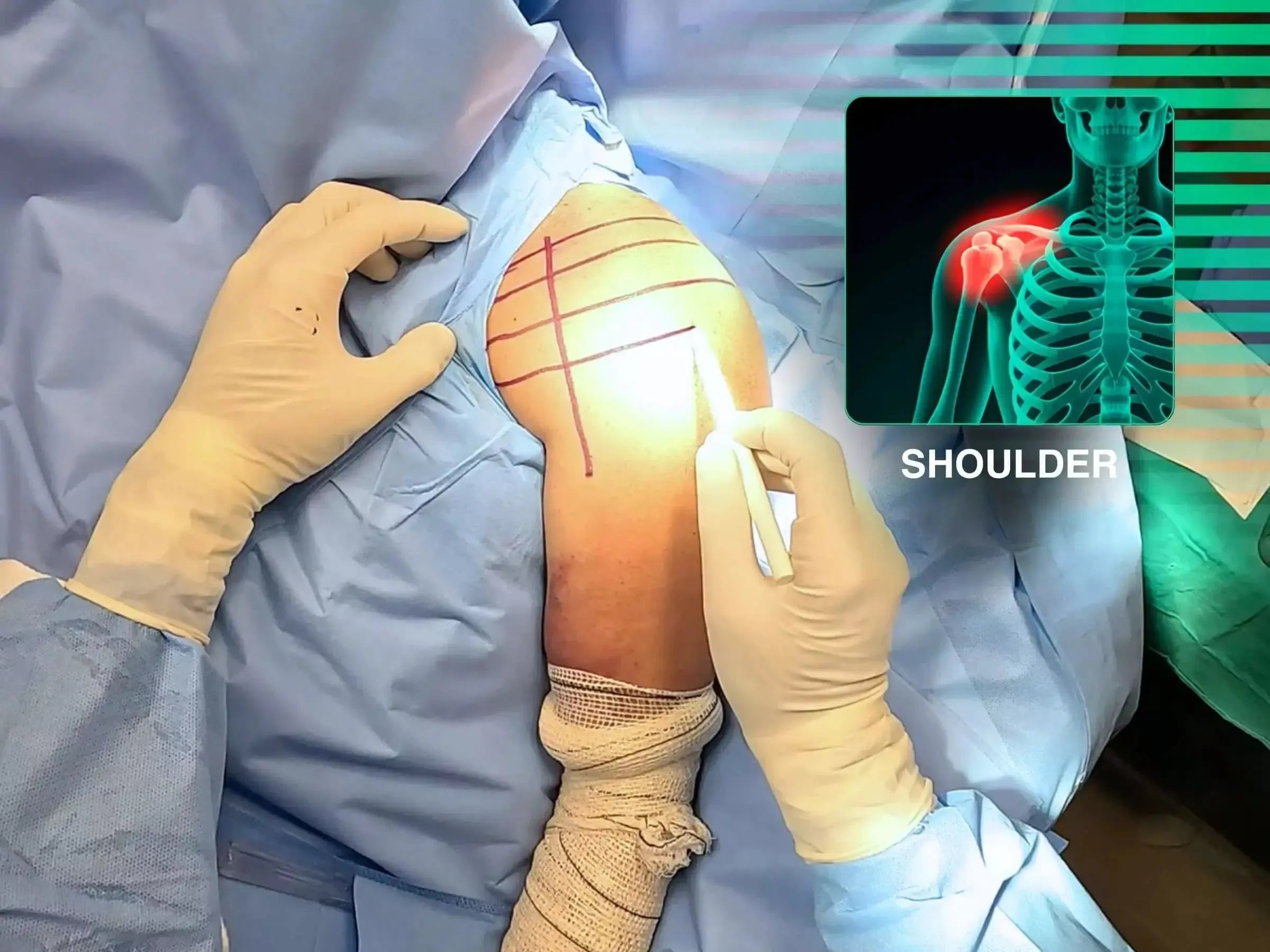 Four-Part Proximal Humerus Fracture (Deltopectoral Approach)