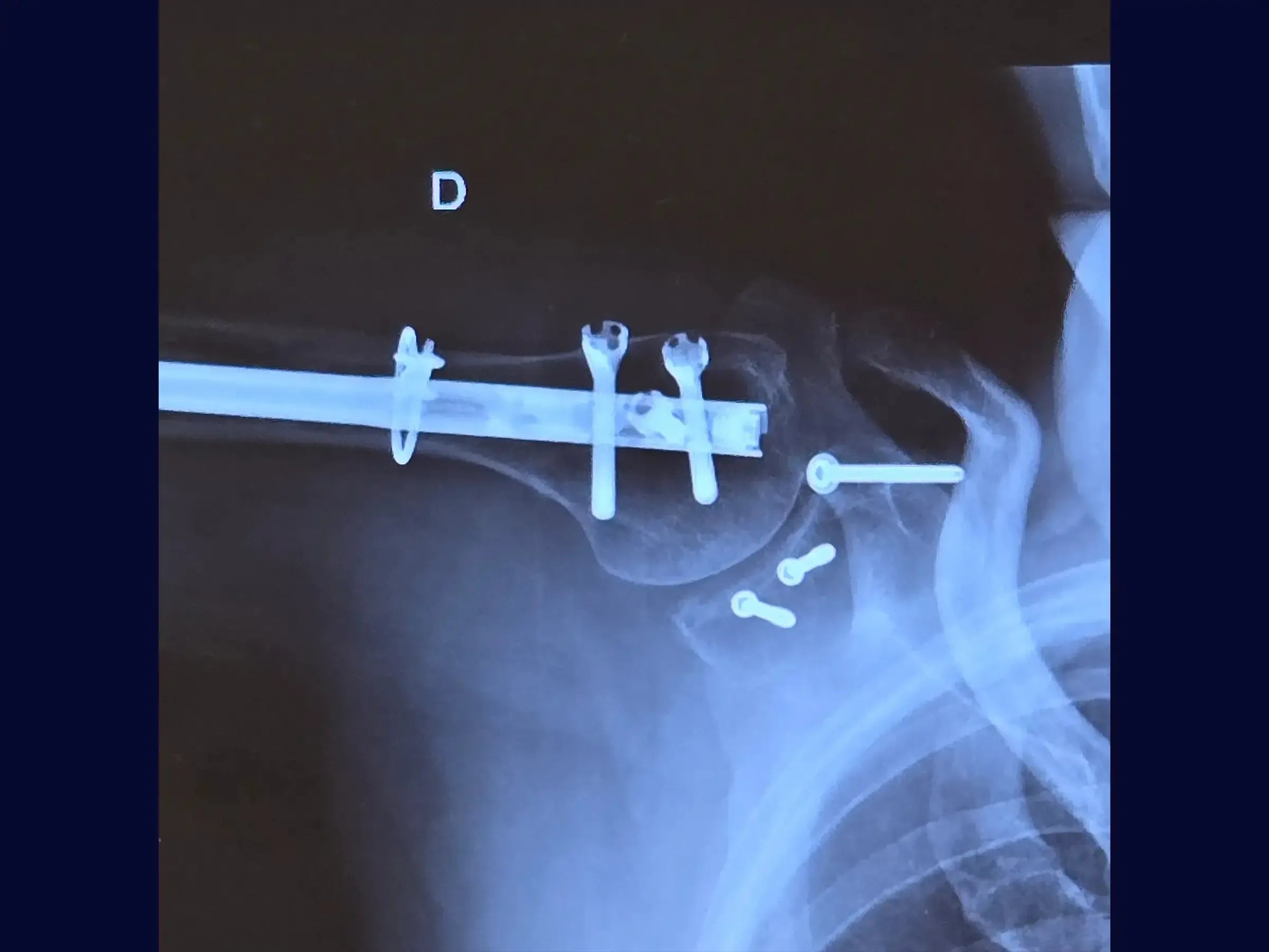 Fracture Fixation of the Glenoid (Combined Procedure Segment)