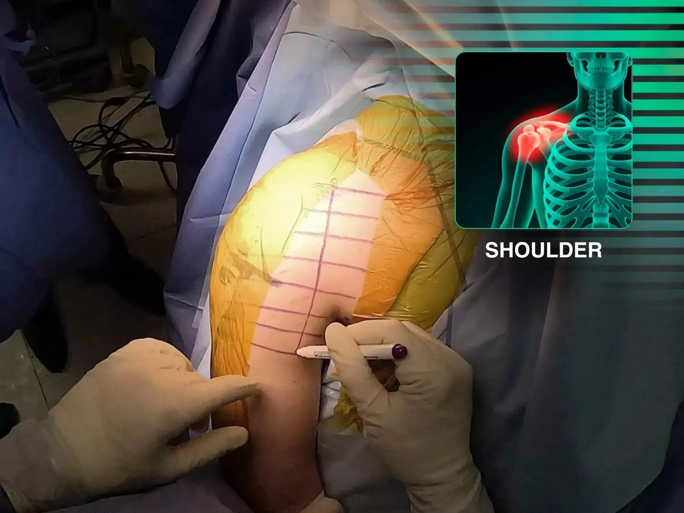 Fracture Fixation of the Glenoid (Combined Procedure Segment)