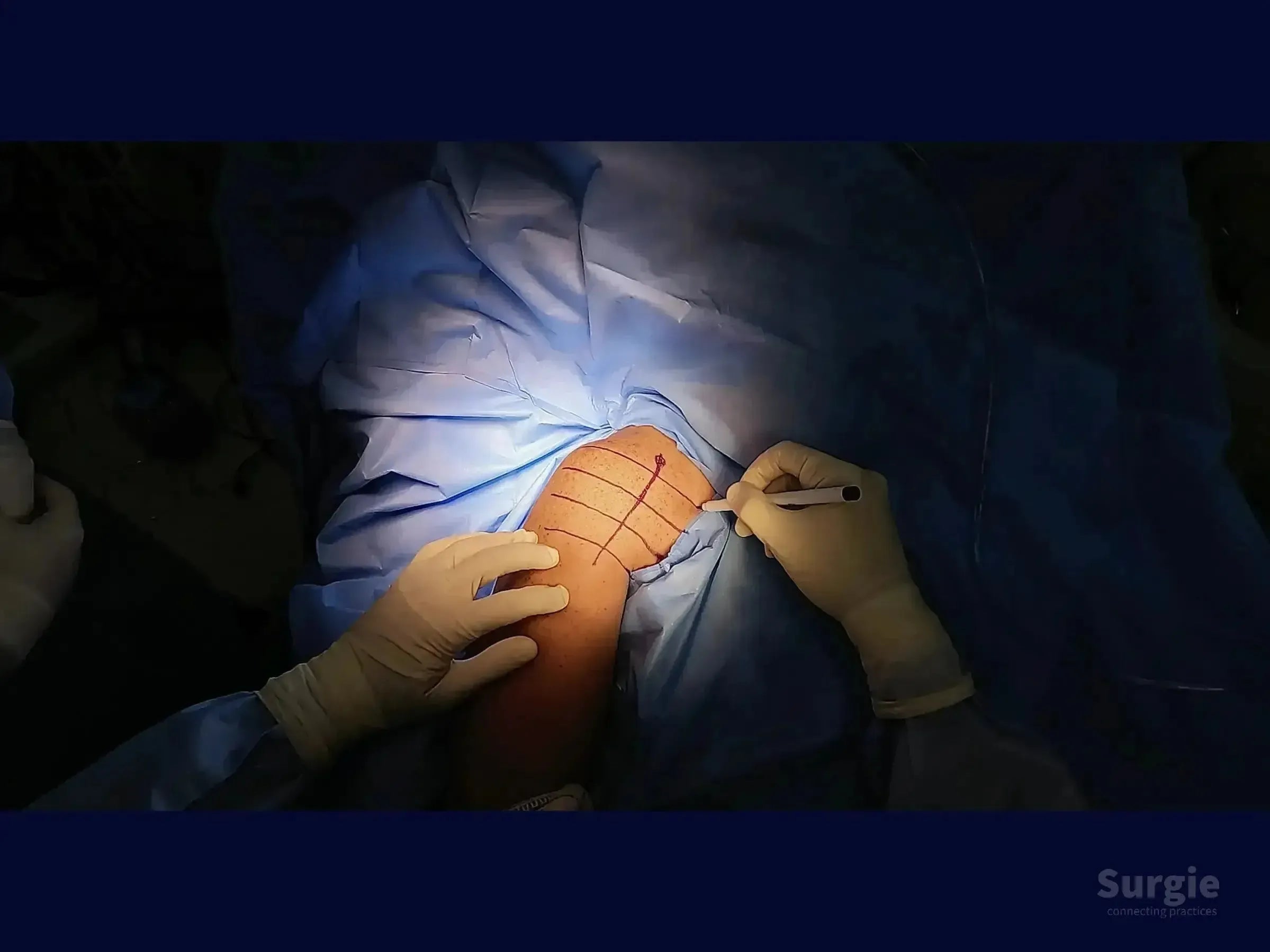 Surgeon marking the deltopectoral incision site on a patient's shoulder with a surgical pen over blue sterile drapes.
