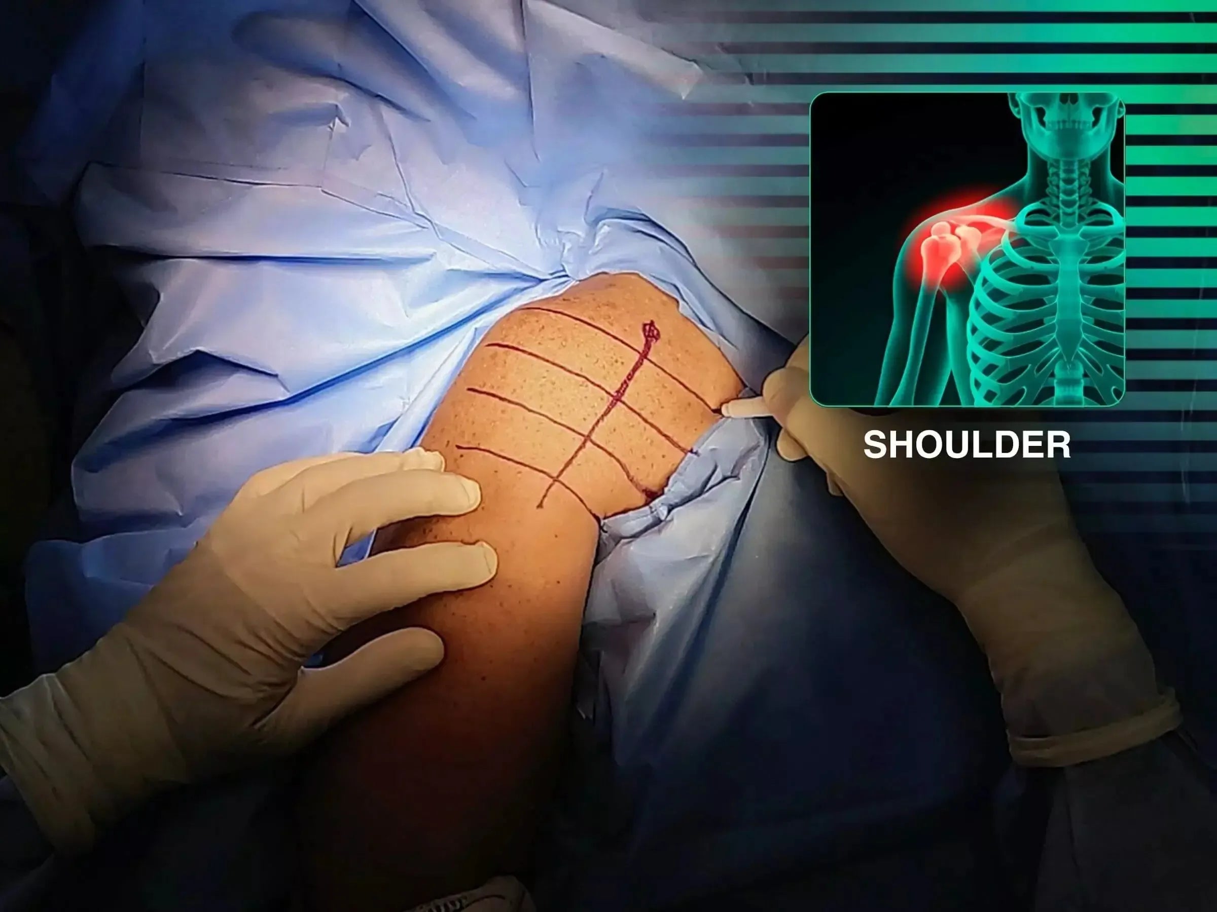Fracture of the Greater Tuberosity of the Humerus with Deltopectoral Approach