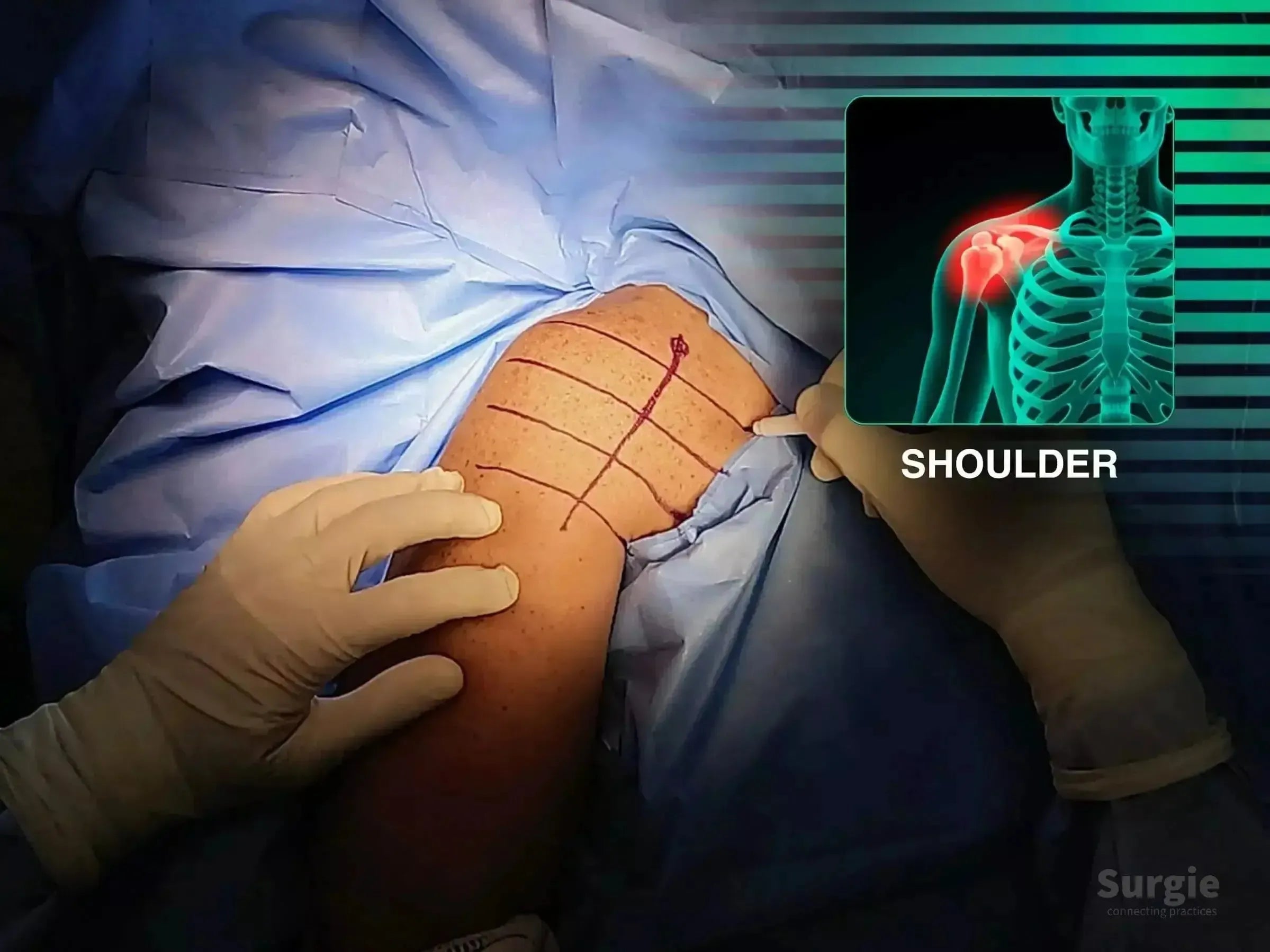 Surgeon marking a shoulder for a deltopectoral approach with a digital anatomical overlay of a humeral fracture.