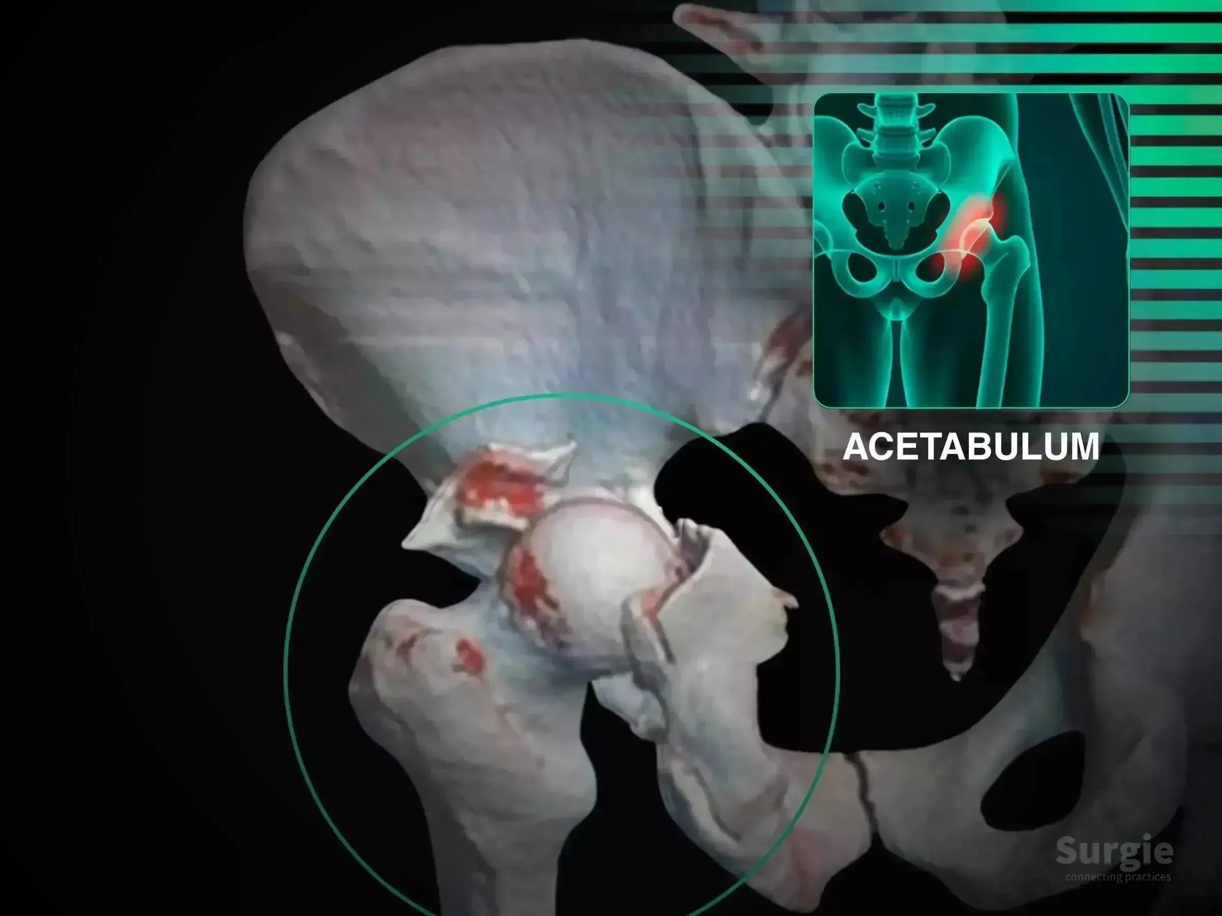 3D medical illustration showing a posterior acetabular wall fracture with hip dislocation and highlighted bone fragments.