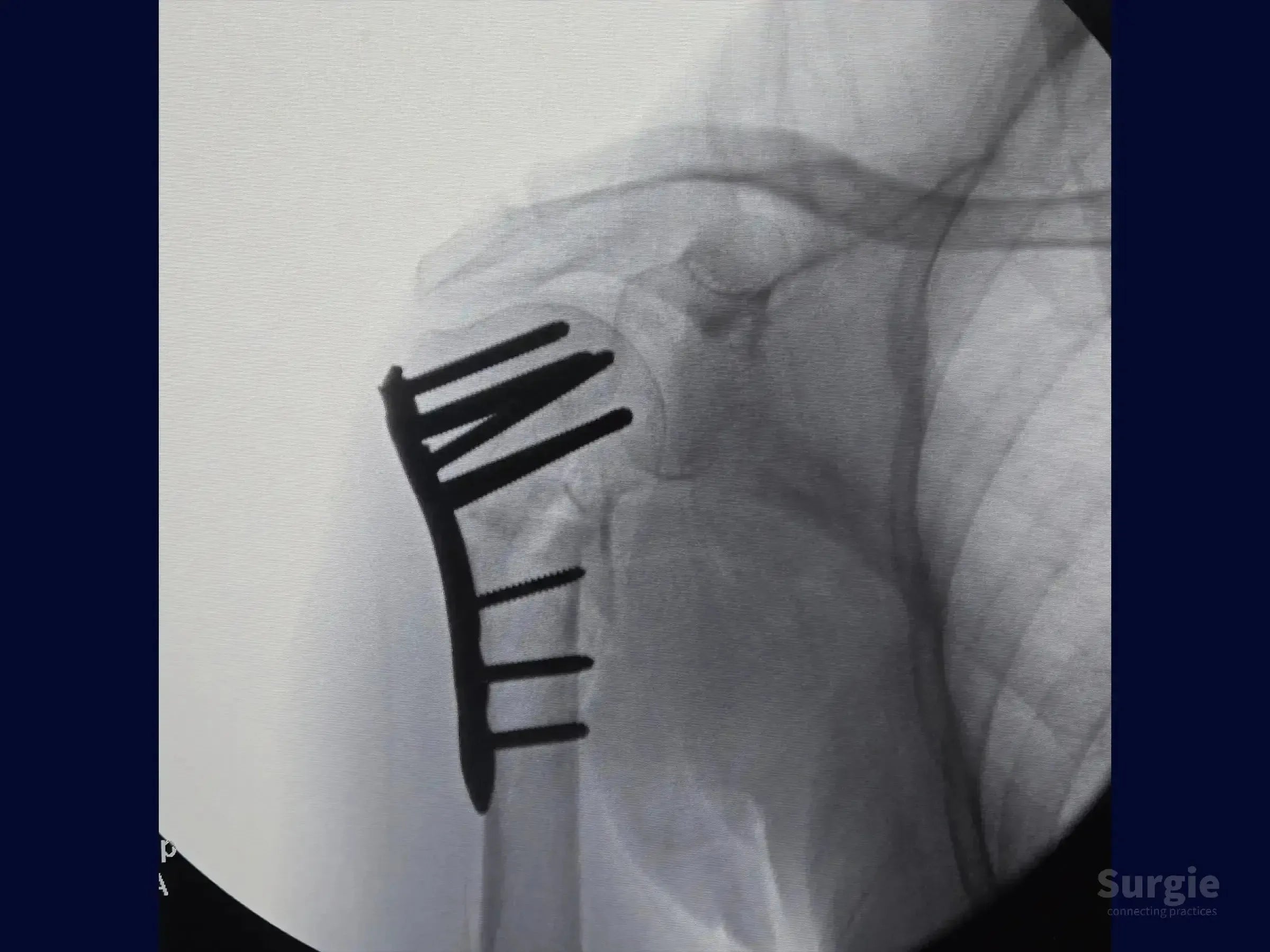 X-ray showing a proximal humerus fracture fixed with a metal plate and multiple subchondral screws.