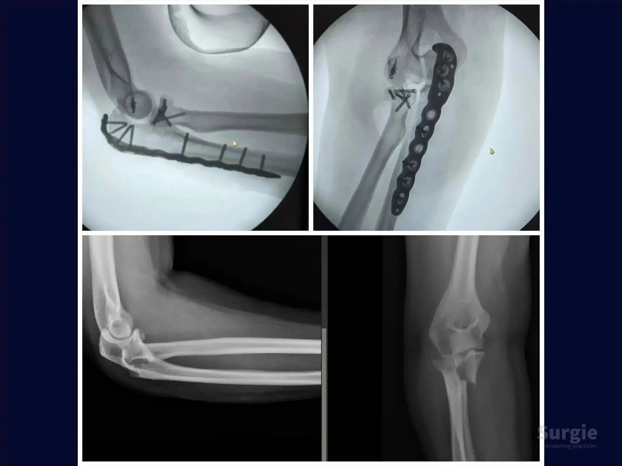 X-ray views of a Monteggia variant elbow fracture showing surgical plate and screw fixation of the ulna and radial head.