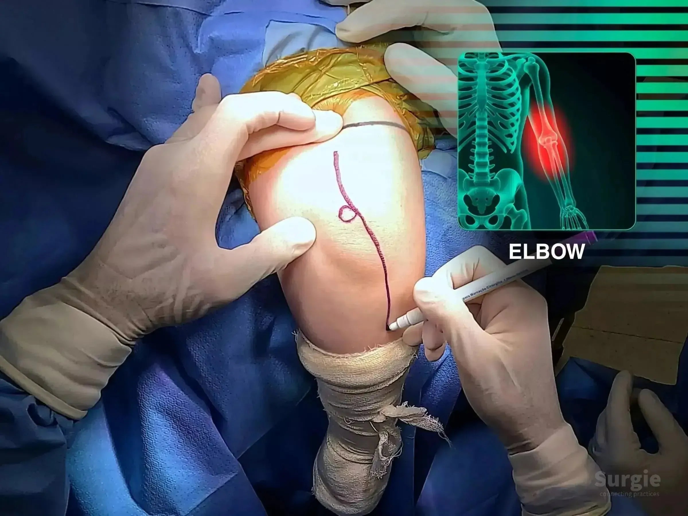 Surgeon marking a posterior elbow incision site for Monteggia variant fracture repair with anatomical overlay.