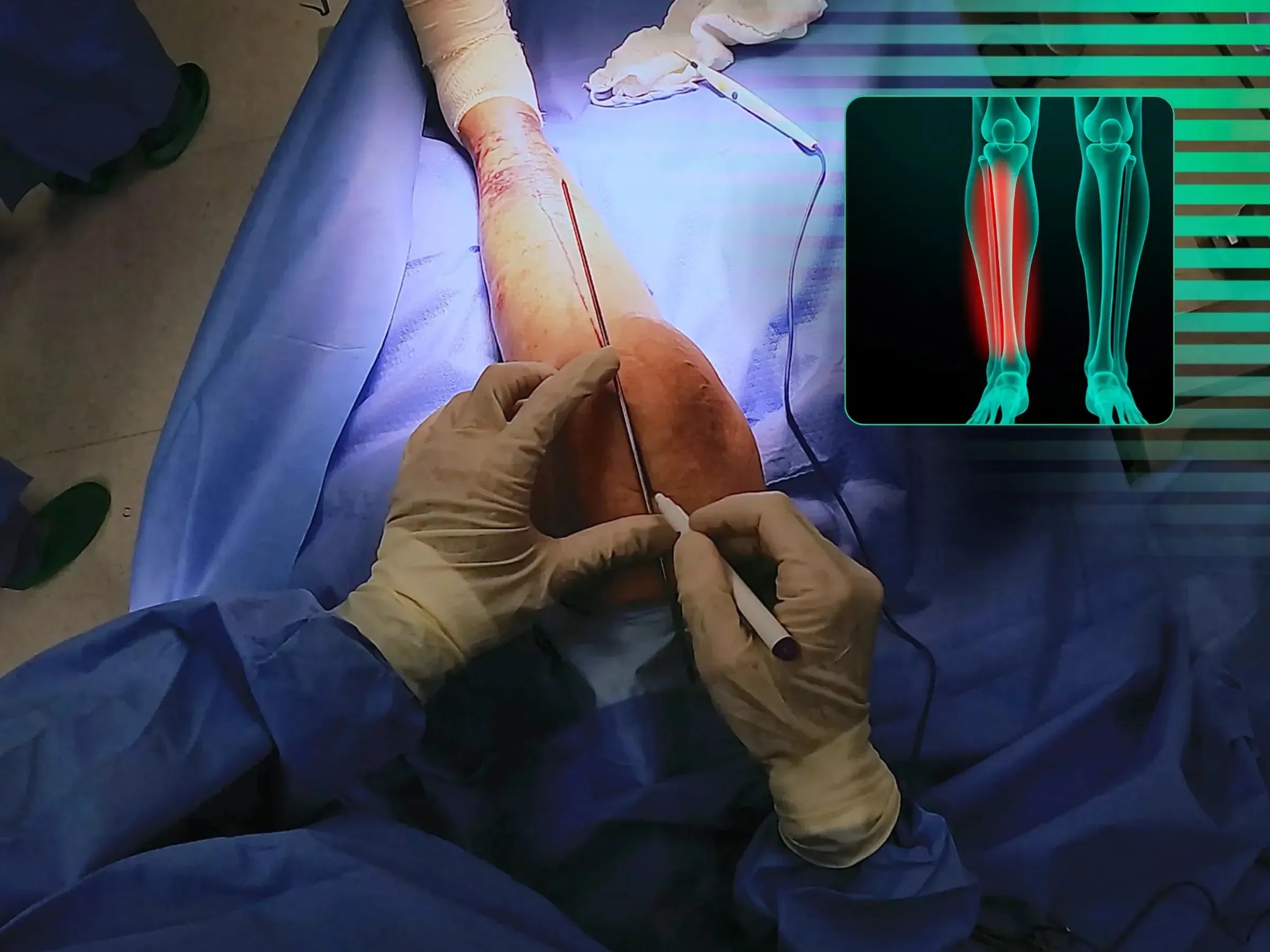 Fratura Diafisária Distal da Tíbia com Fixação por Haste Intramedular via Abordagem Suprapatelar