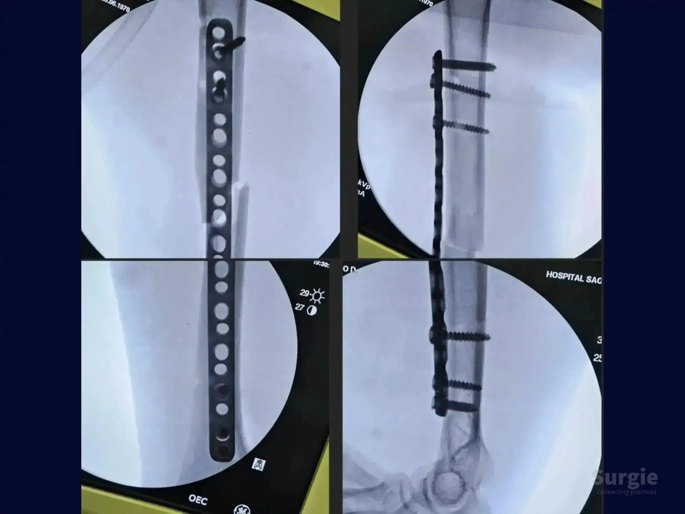 X-ray showing a humeral shaft fracture stabilized with a metal bridge plate and surgical screws for osteosynthesis.