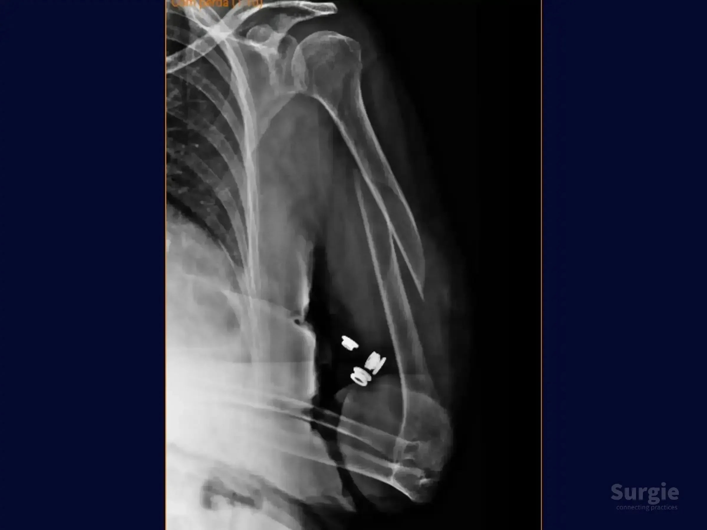 X-ray showing a humeral shaft fracture treated with an intramedullary nail and locking screws in the distal humerus.