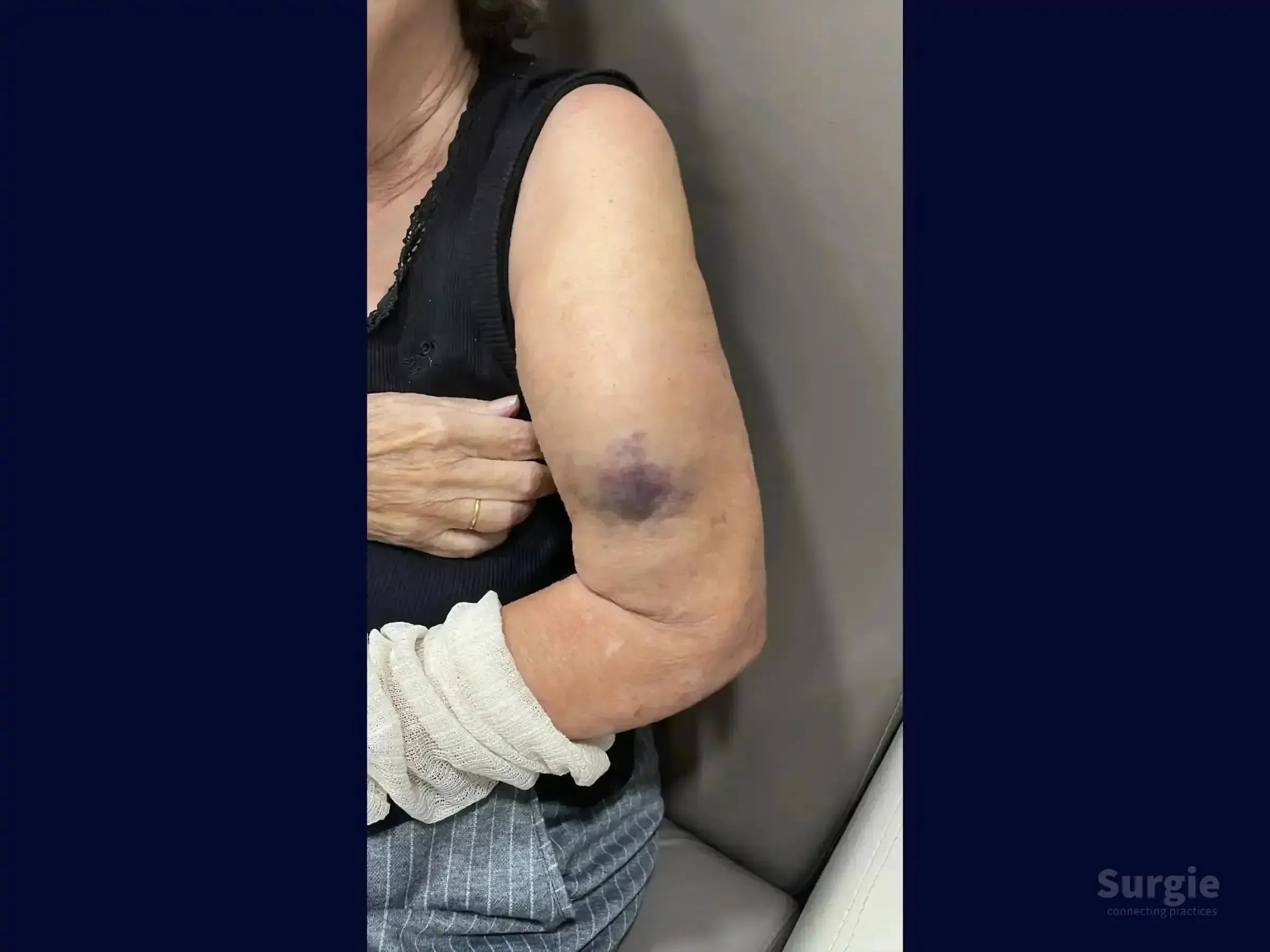 Large purple hematoma on the upper arm indicating a humeral shaft fracture in an elderly patient.