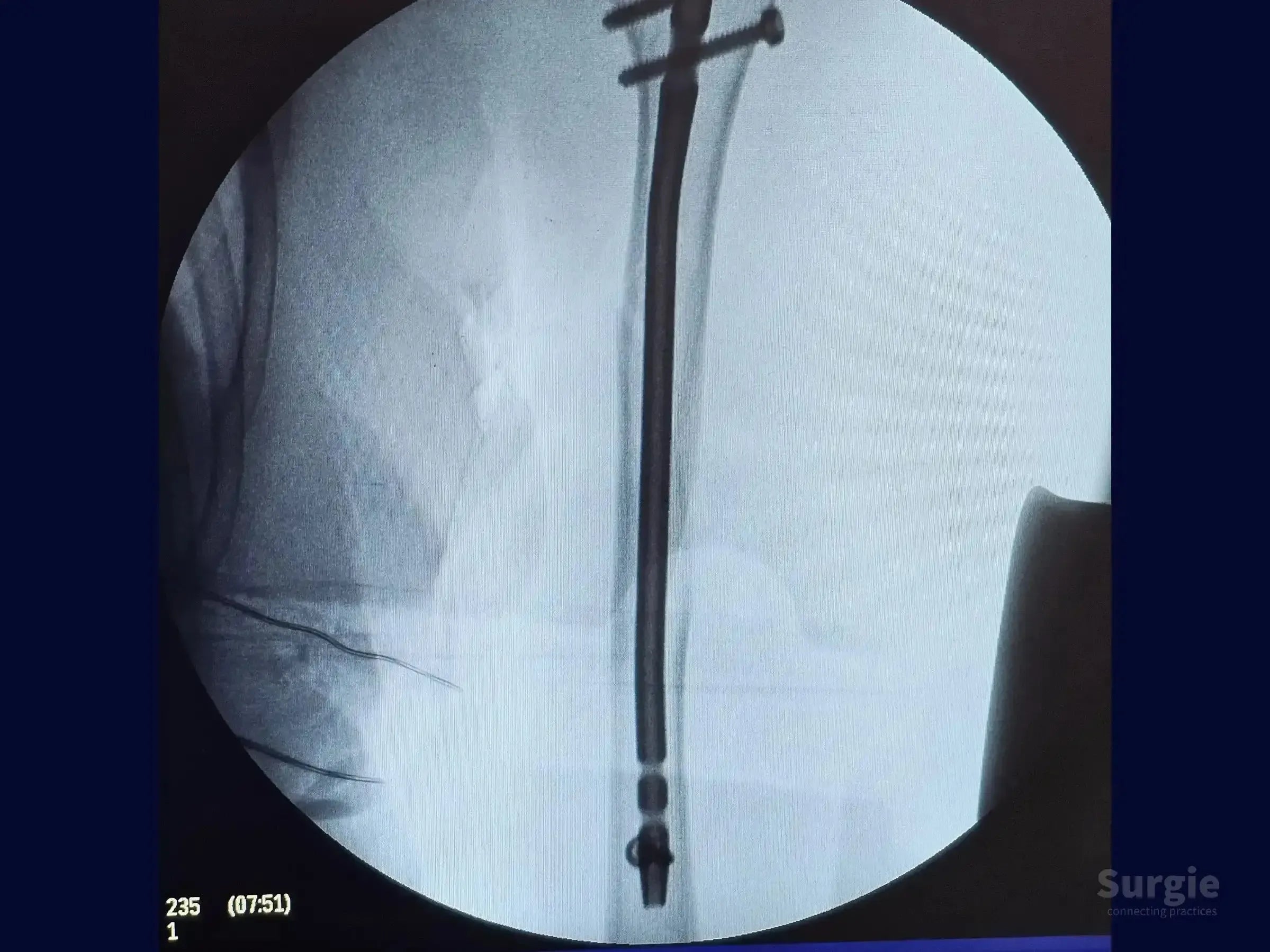 Fluoroscopic X-ray showing a humeral intramedullary nail with proximal locking screws in a fractured humerus.