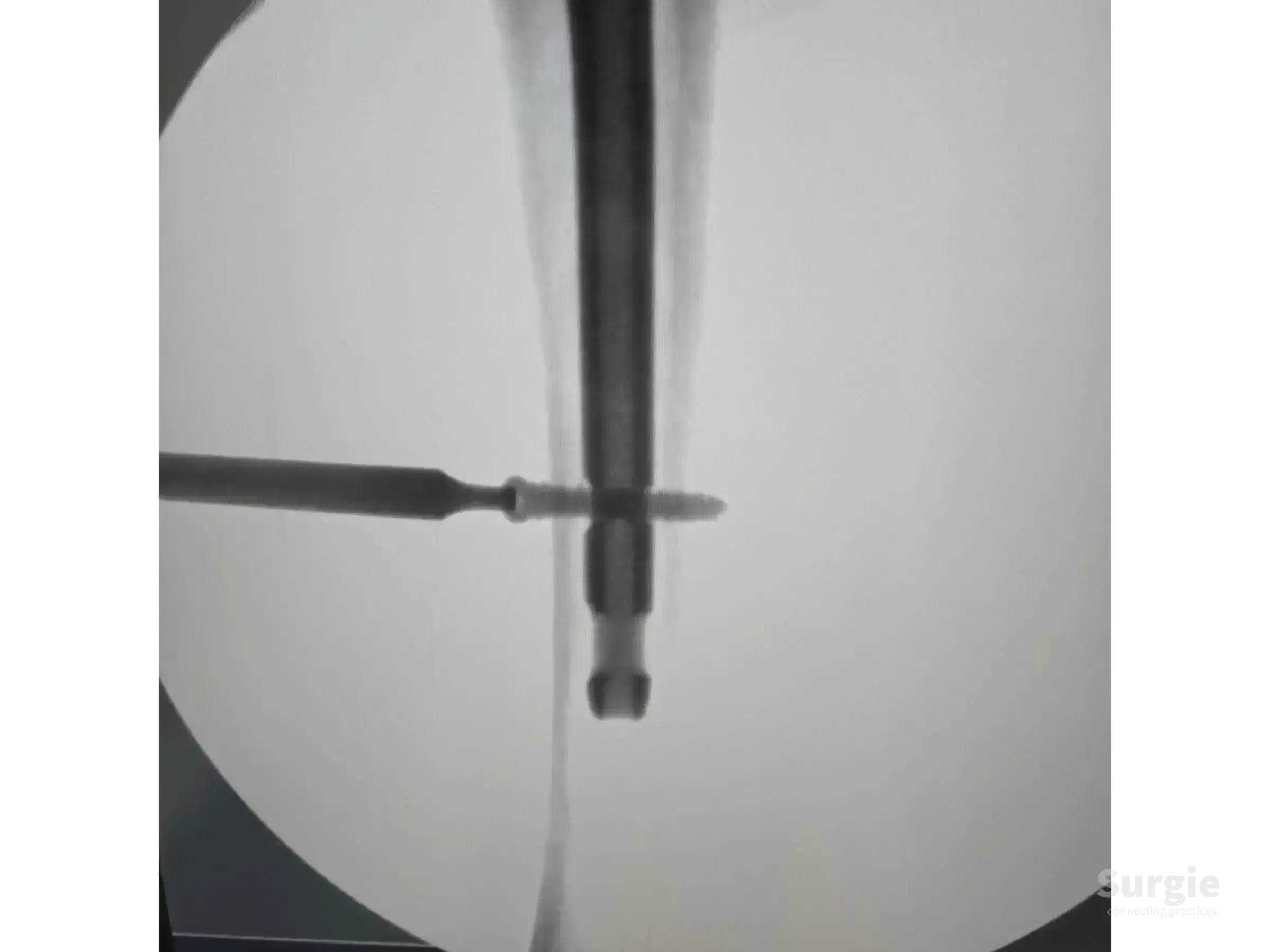 Fluoroscopic view of a metallic intramedullary nail and cephalic screw inserted into a proximal femur during surgery.