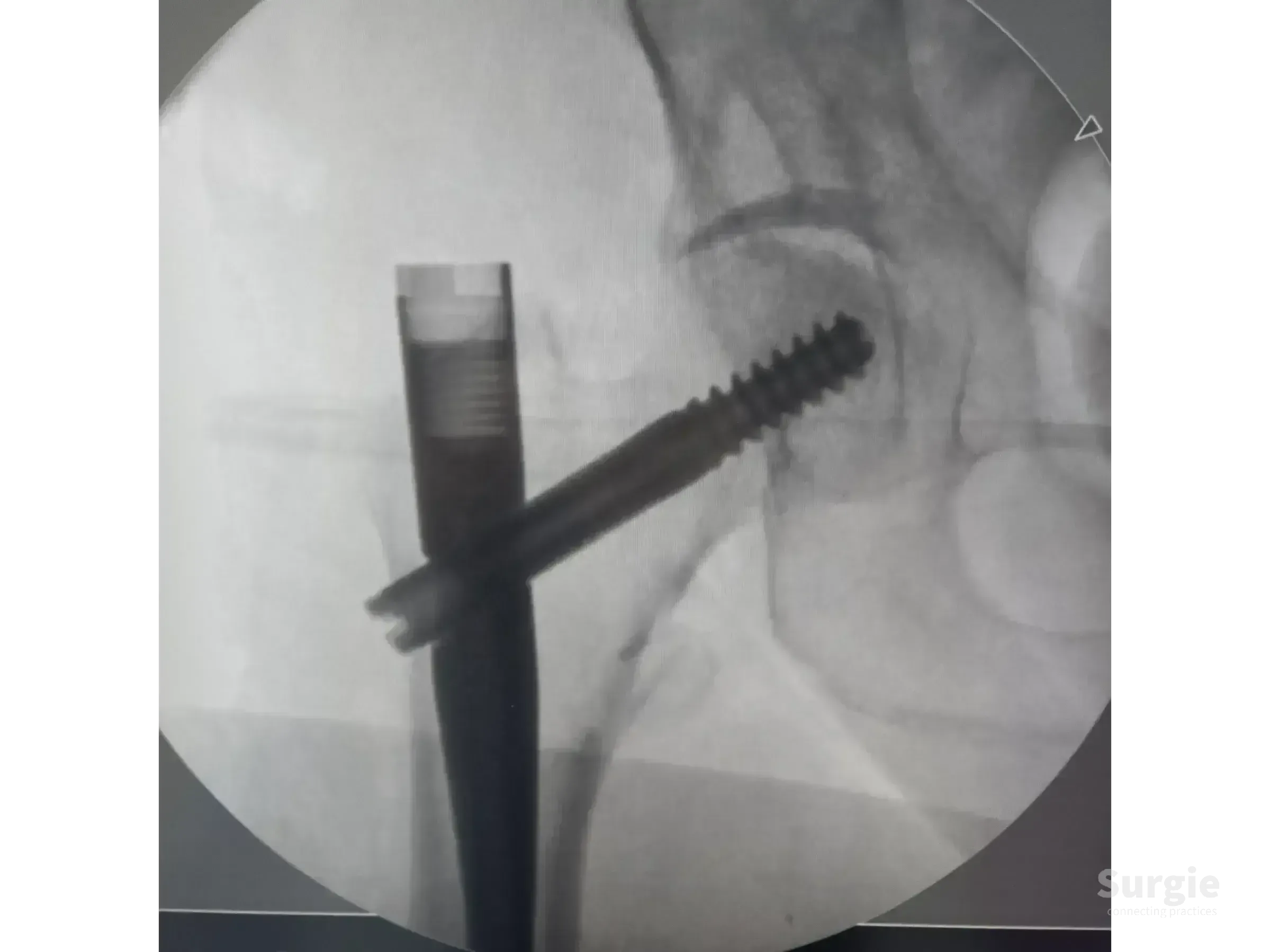 Fluoroscopic view of a proximal femoral intramedullary nail with a cephalic screw inserted into the femoral head.