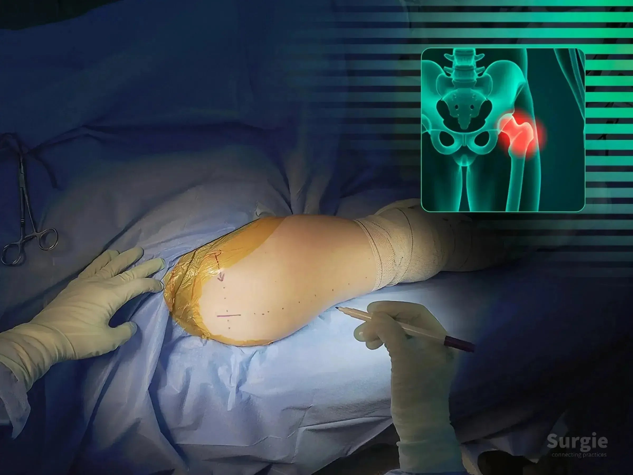 Surgeon marking a patient's hip for proximal femur intramedullary nail surgery with a digital anatomical overlay.