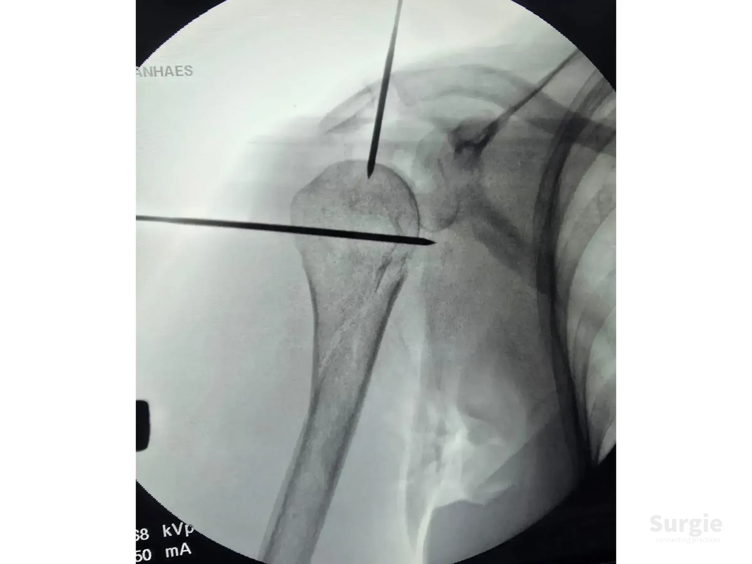 Fluoroscopic X-ray showing Kirschner wires inserted into a proximal humerus fracture for surgical stabilization.