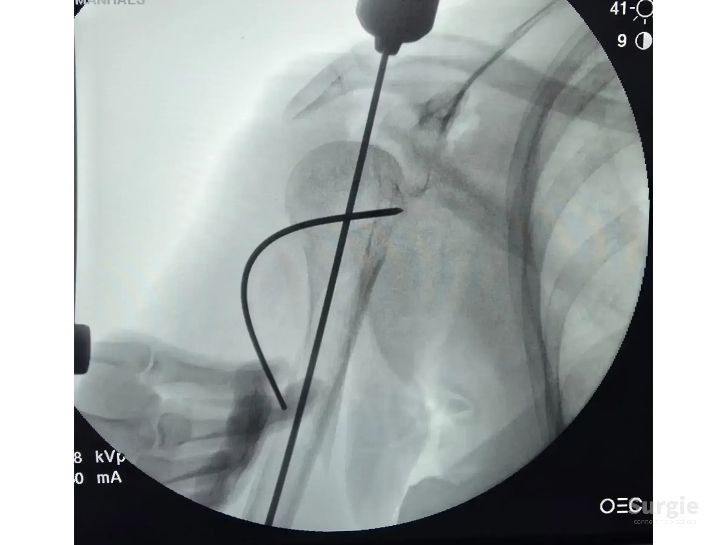 Fluoroscopic view of a proximal humerus fracture stabilized with a guide wire and Kirschner wire joystick technique.