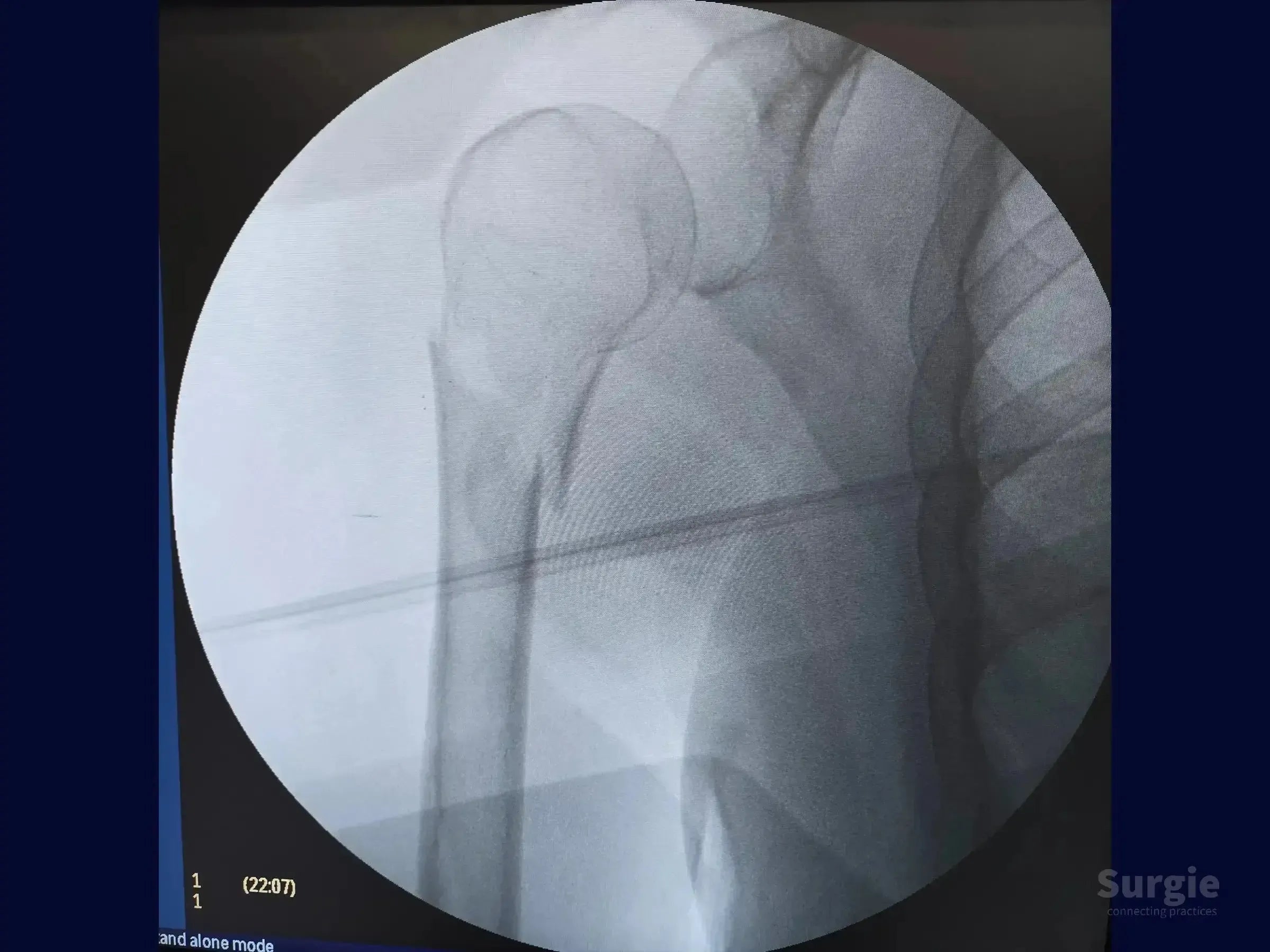 Fluoroscopic X-ray showing a proximal humerus fracture with a metallic guidewire inserted for intramedullary nail fixation.