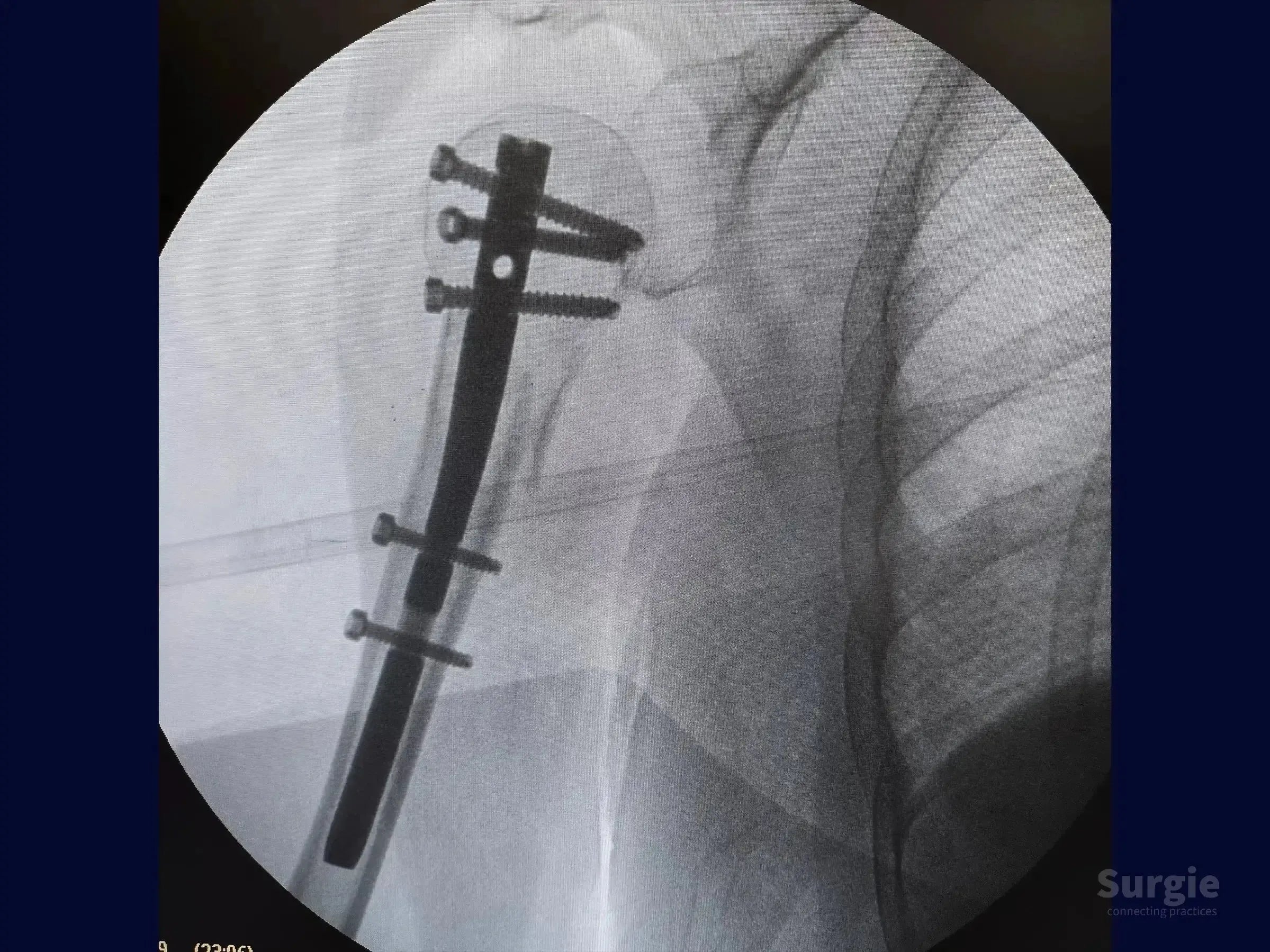 Fluoroscopic X-ray showing a metallic intramedullary nail with proximal and distal locking screws in a humerus fracture.