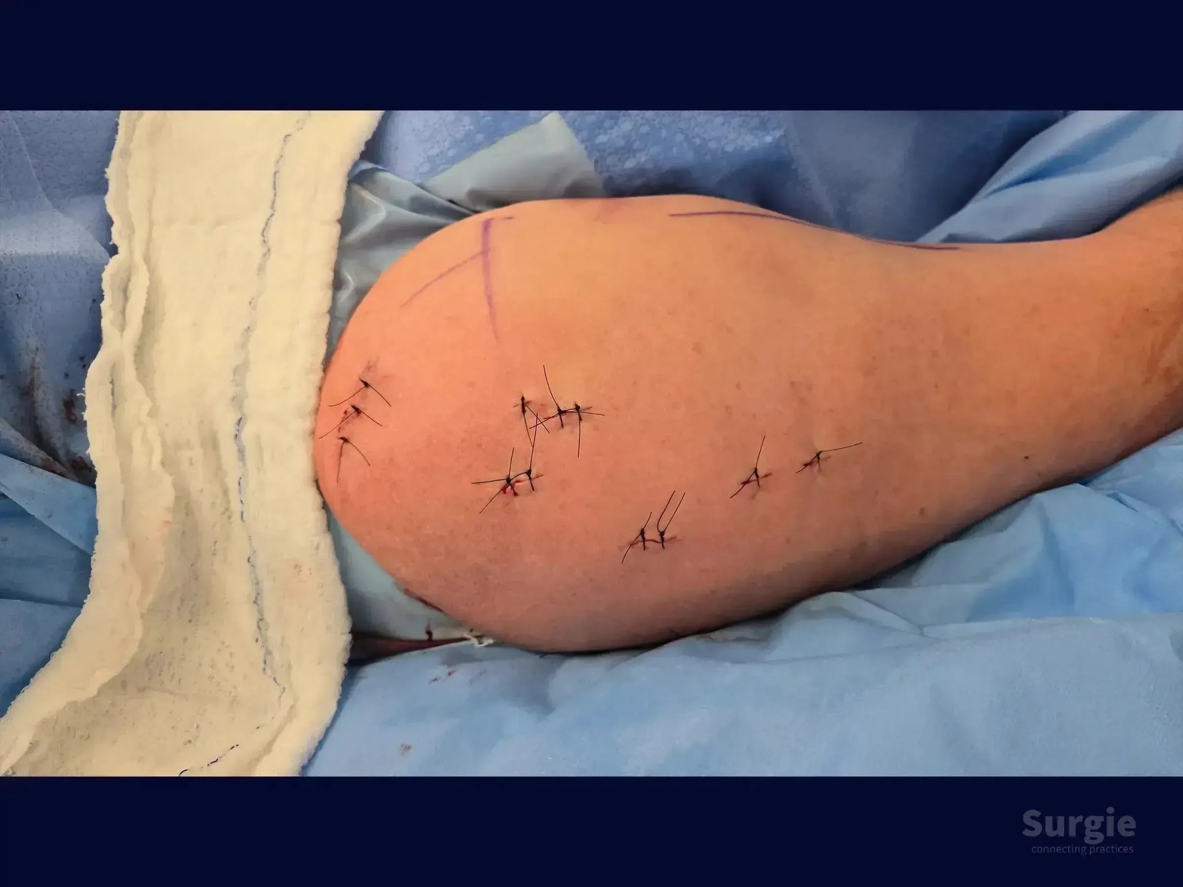 Surgical site on a human shoulder showing multiple small incisions closed with black sutures after minimally invasive surgery.