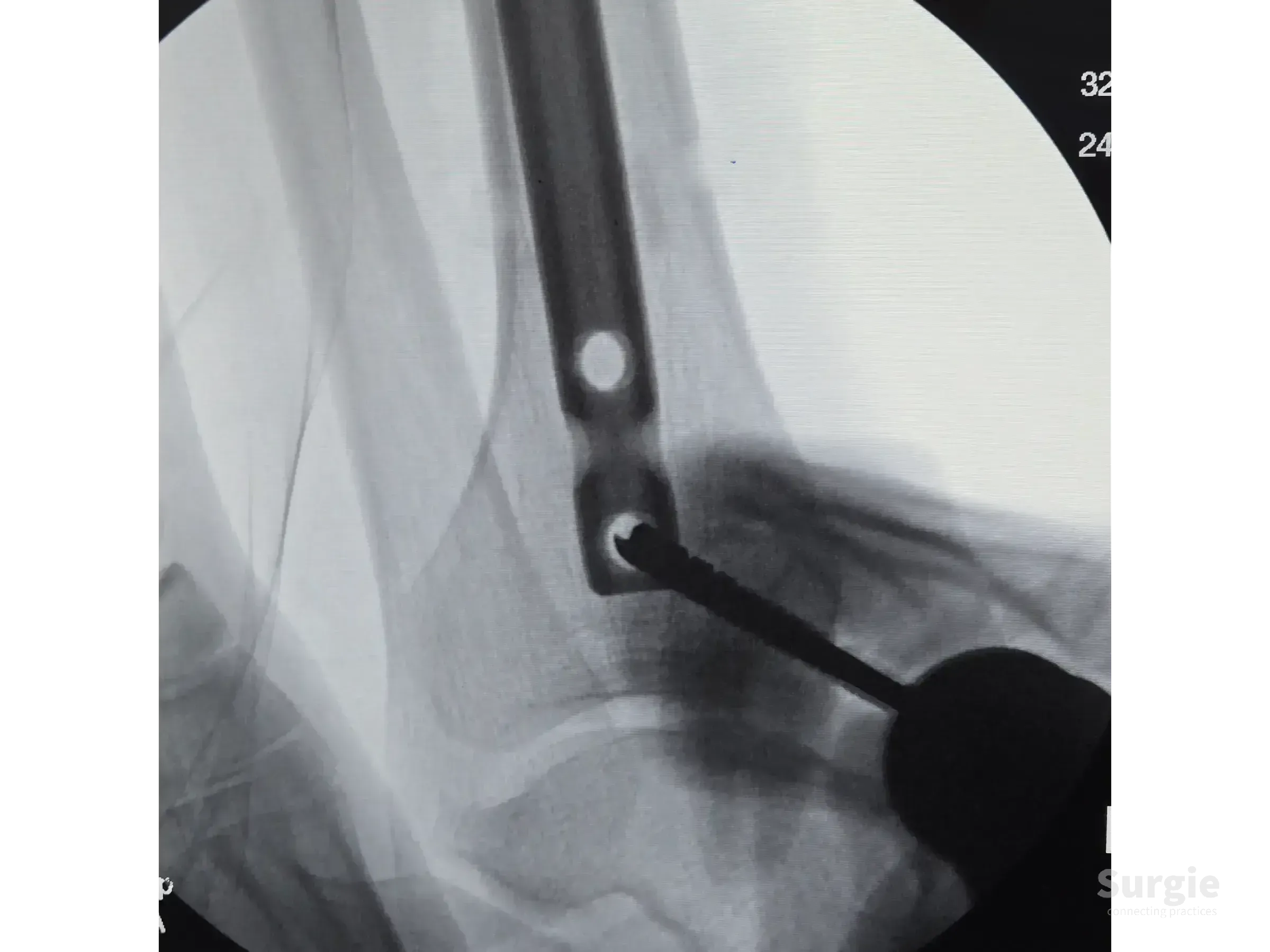 Fluoroscopic view of an intramedullary tibial nail being locked with a screw during infra-patellar surgery.