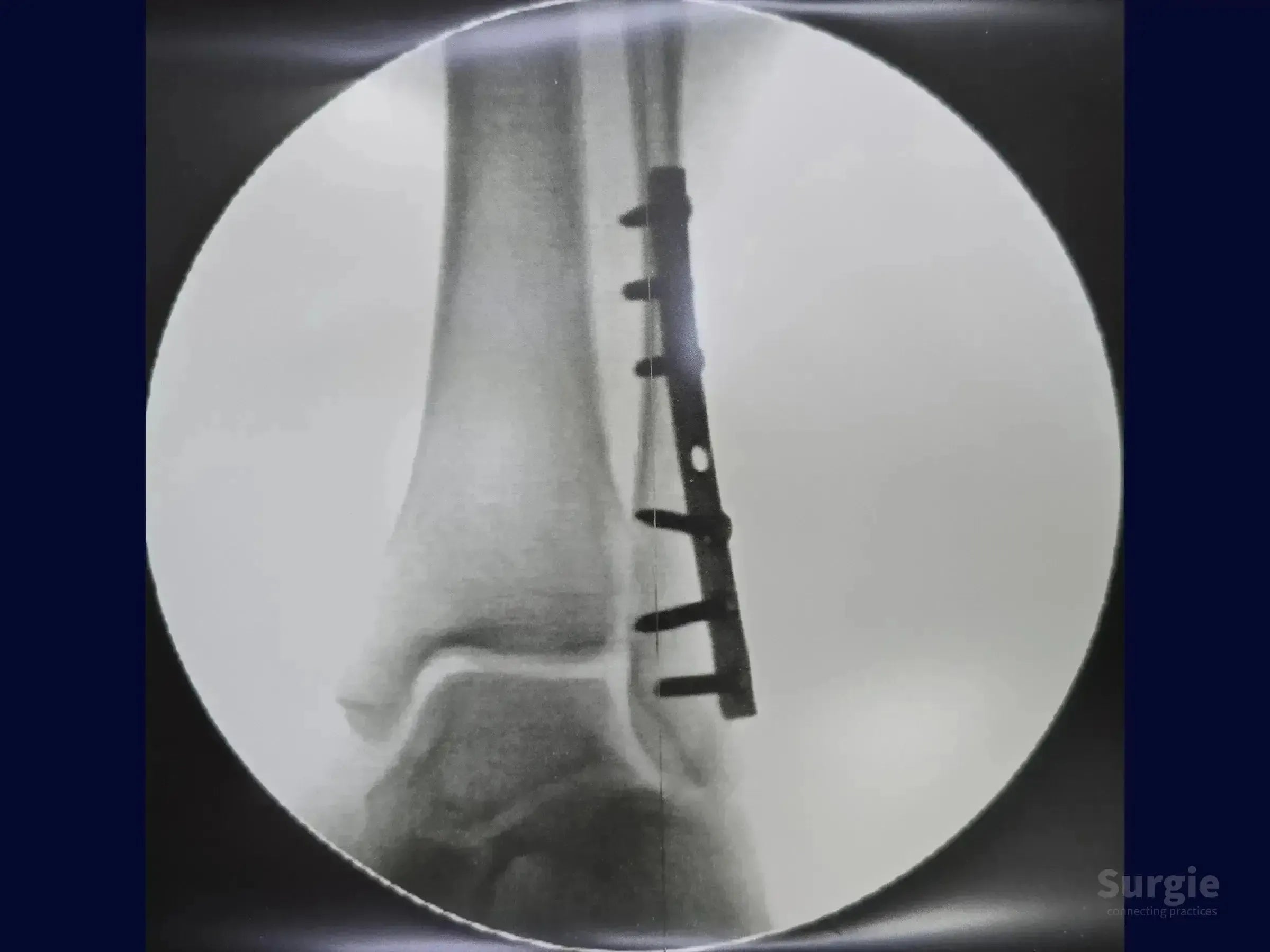 X-ray showing a metal posterior plate fixed to a fractured lateral malleolus with surgical screws.
