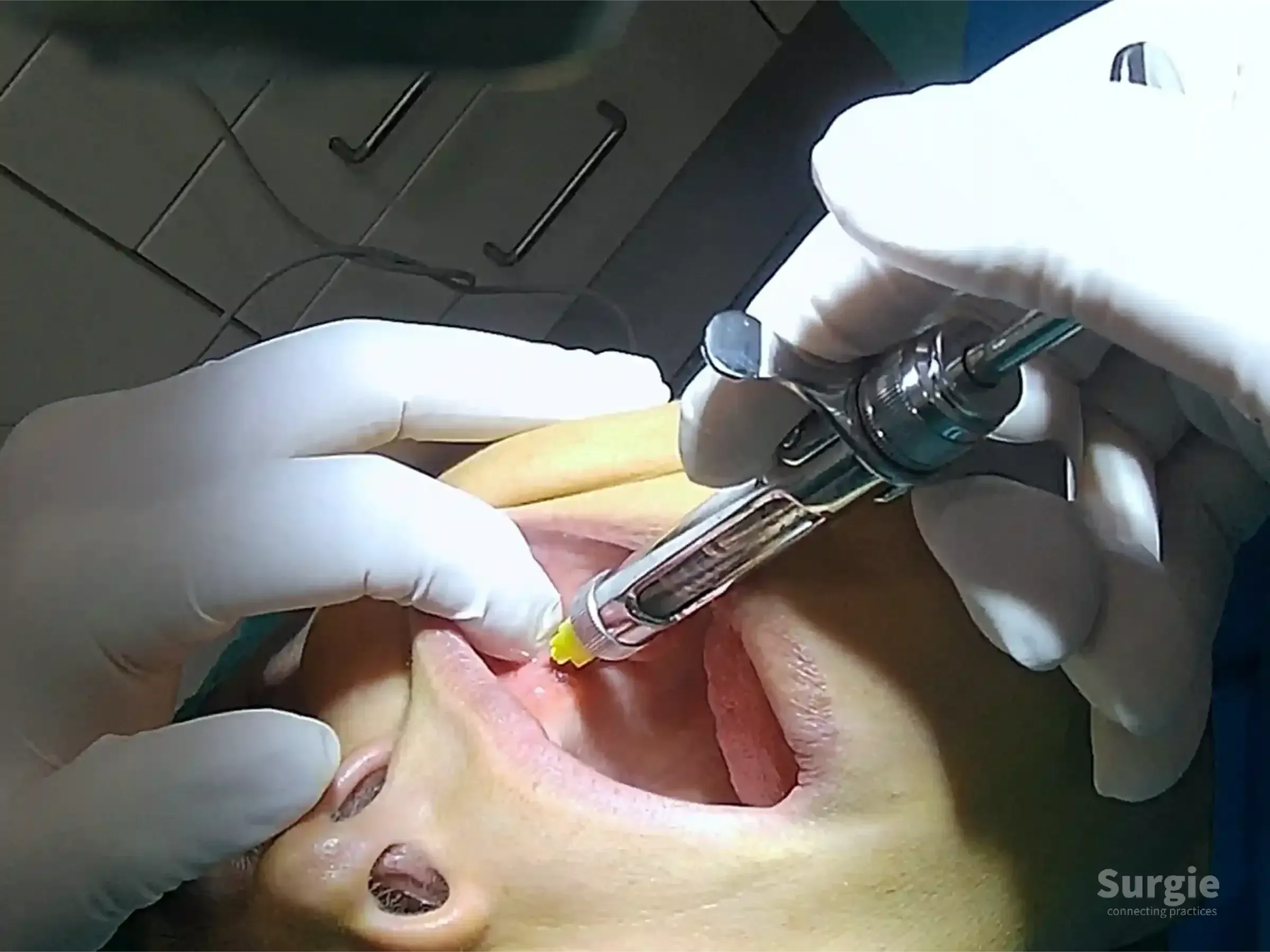 Dentist in white gloves administering local anesthesia to a patient's upper gum line with a metal dental syringe.