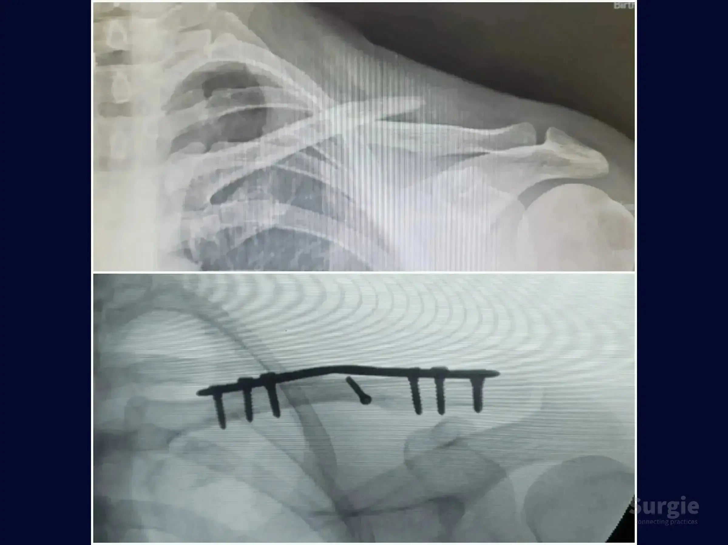 X-ray showing a midshaft clavicle fracture before and after bridge plate fixation with screws.