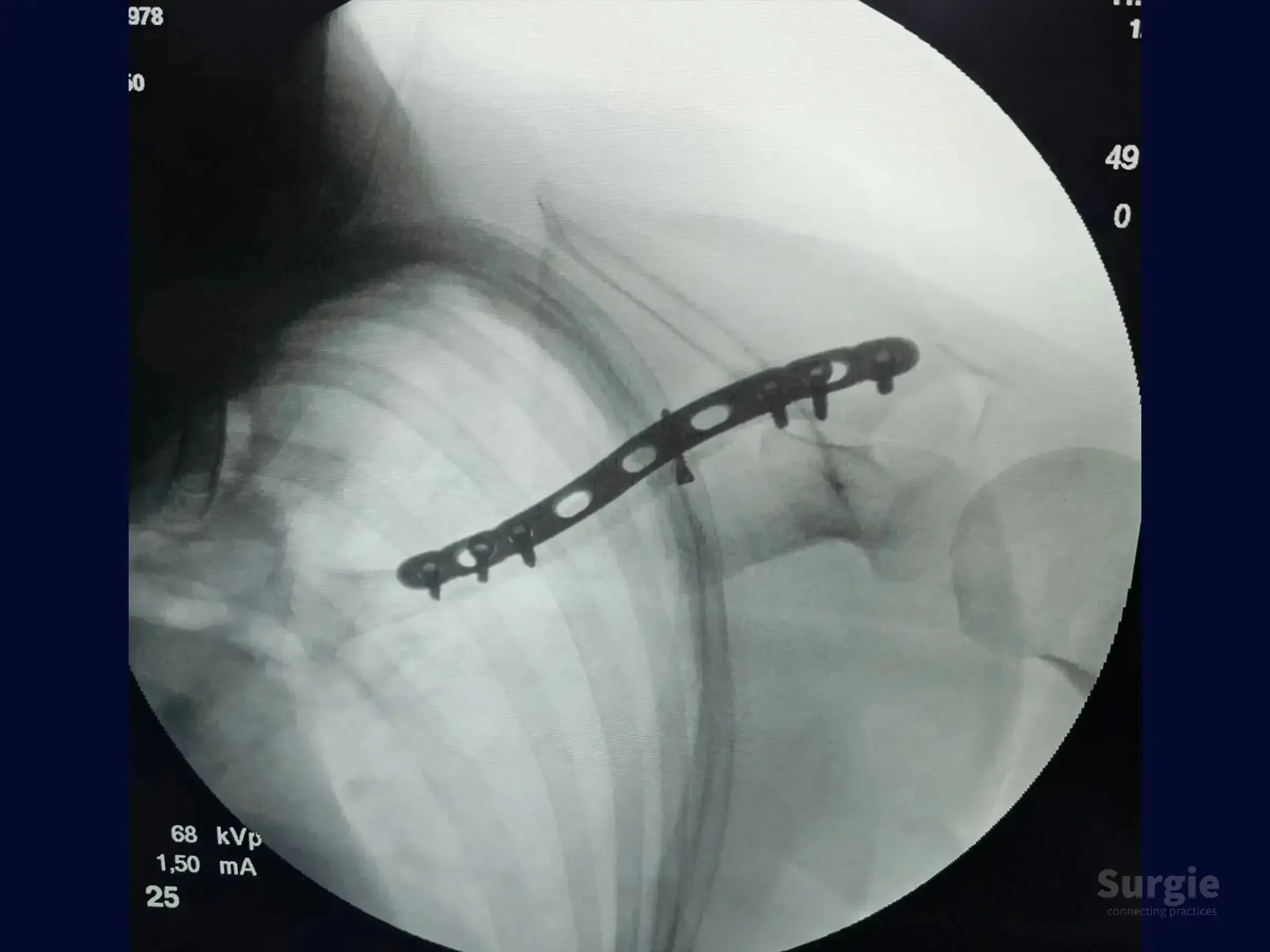 X-ray showing a metal bridge plate fixed to a fractured clavicle with surgical screws.