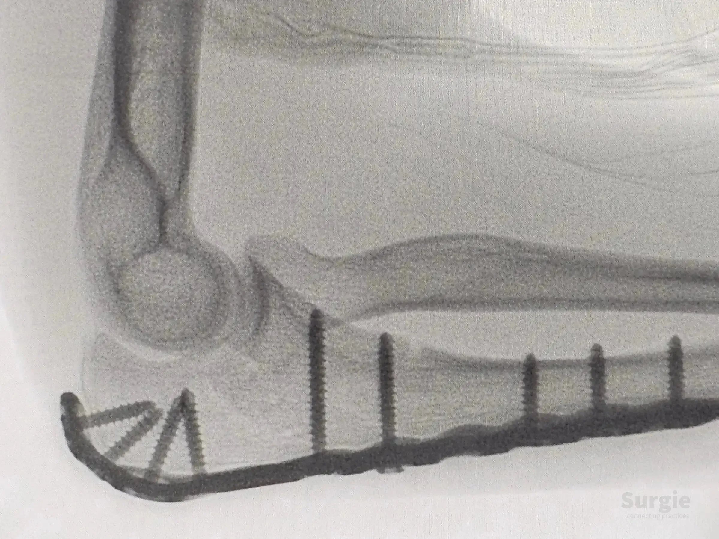 X-ray showing a metal plate and screws fixating an olecranon fracture for stable anatomical reduction.