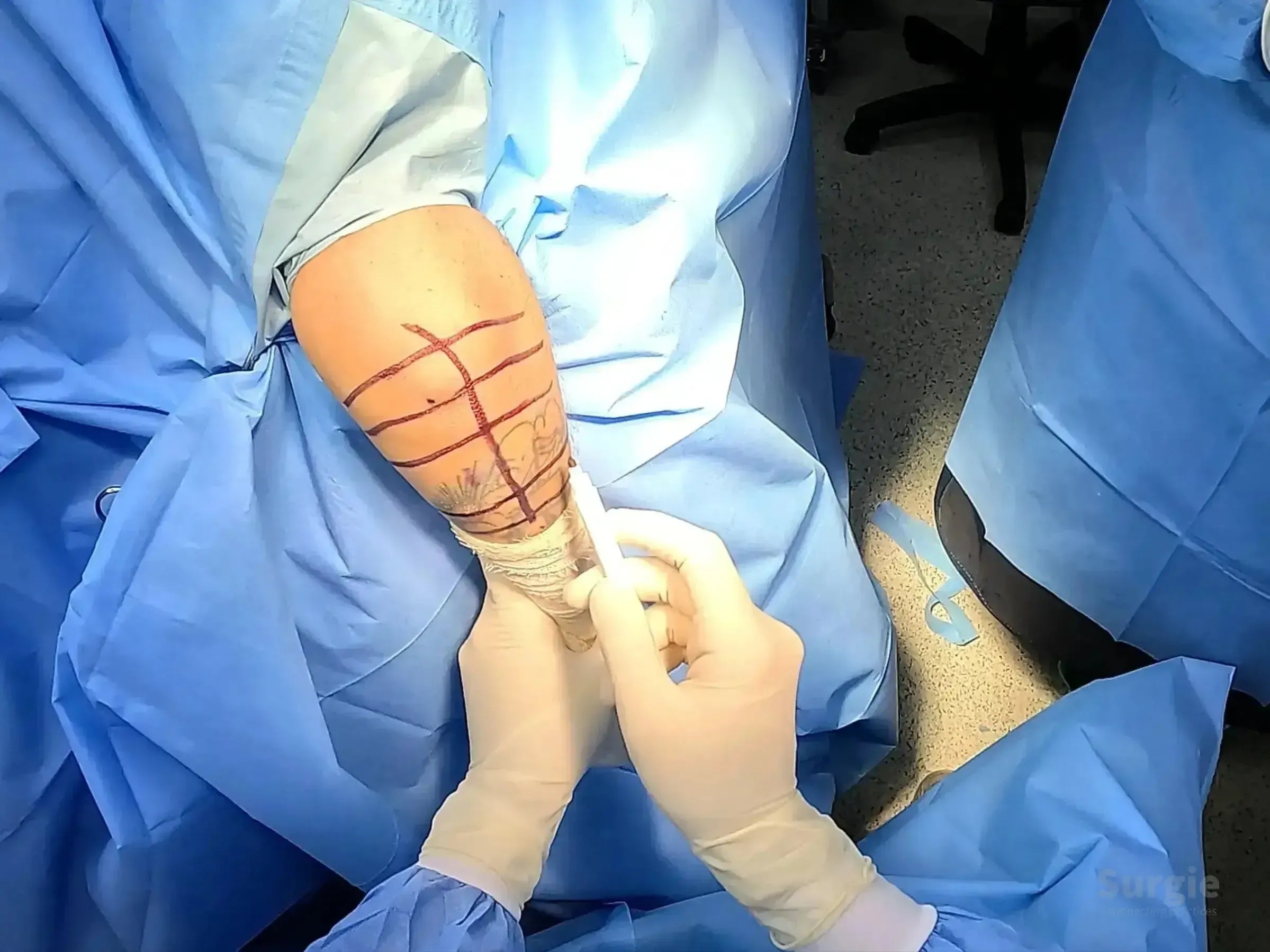 Surgeon marking a patient's elbow with a surgical pen for minimally invasive olecranon fracture osteosynthesis.