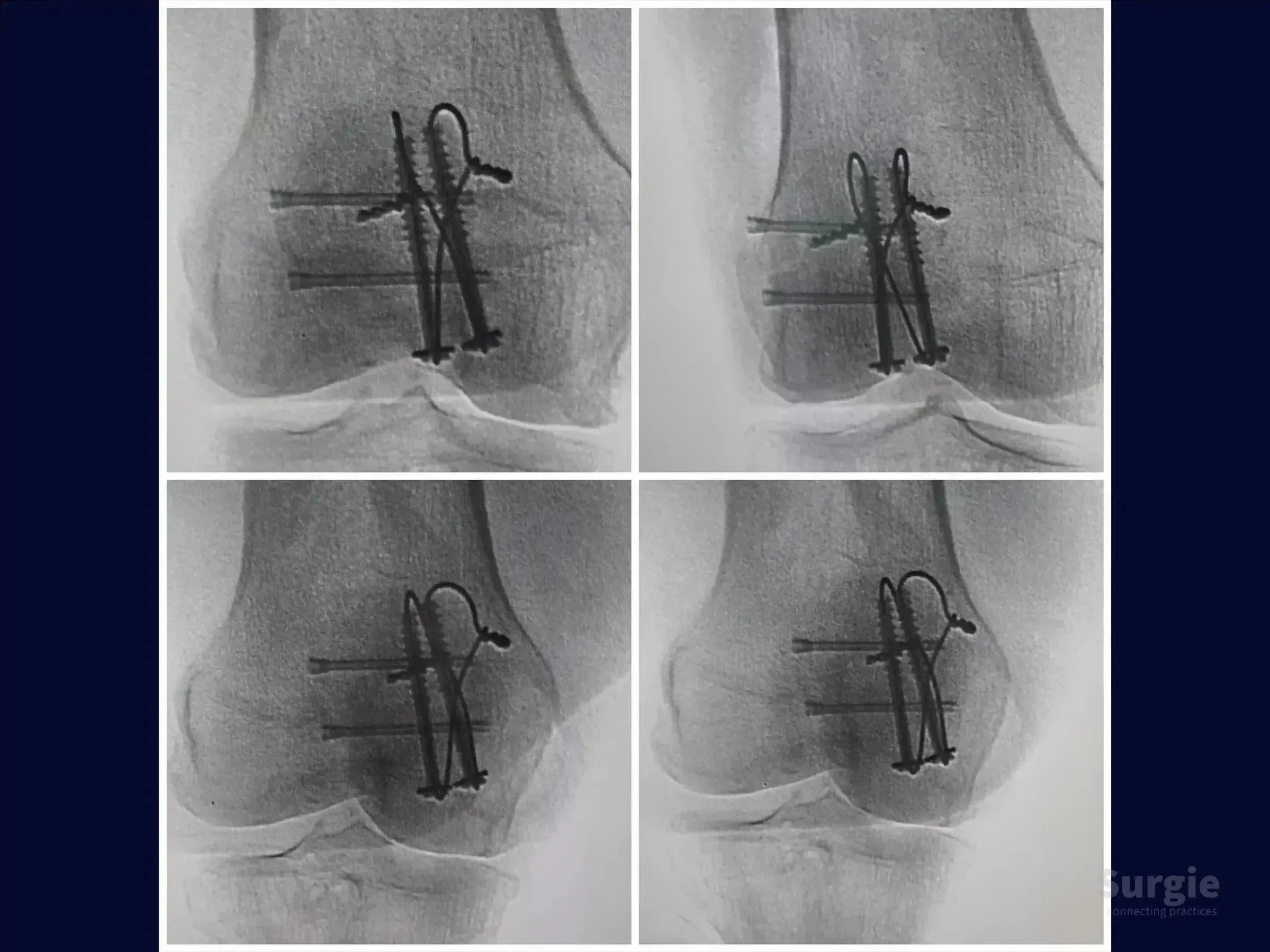 X-ray showing multi-fragmentary patella fracture fixation using cannulated screws and cerclage wiring for stable reduction.