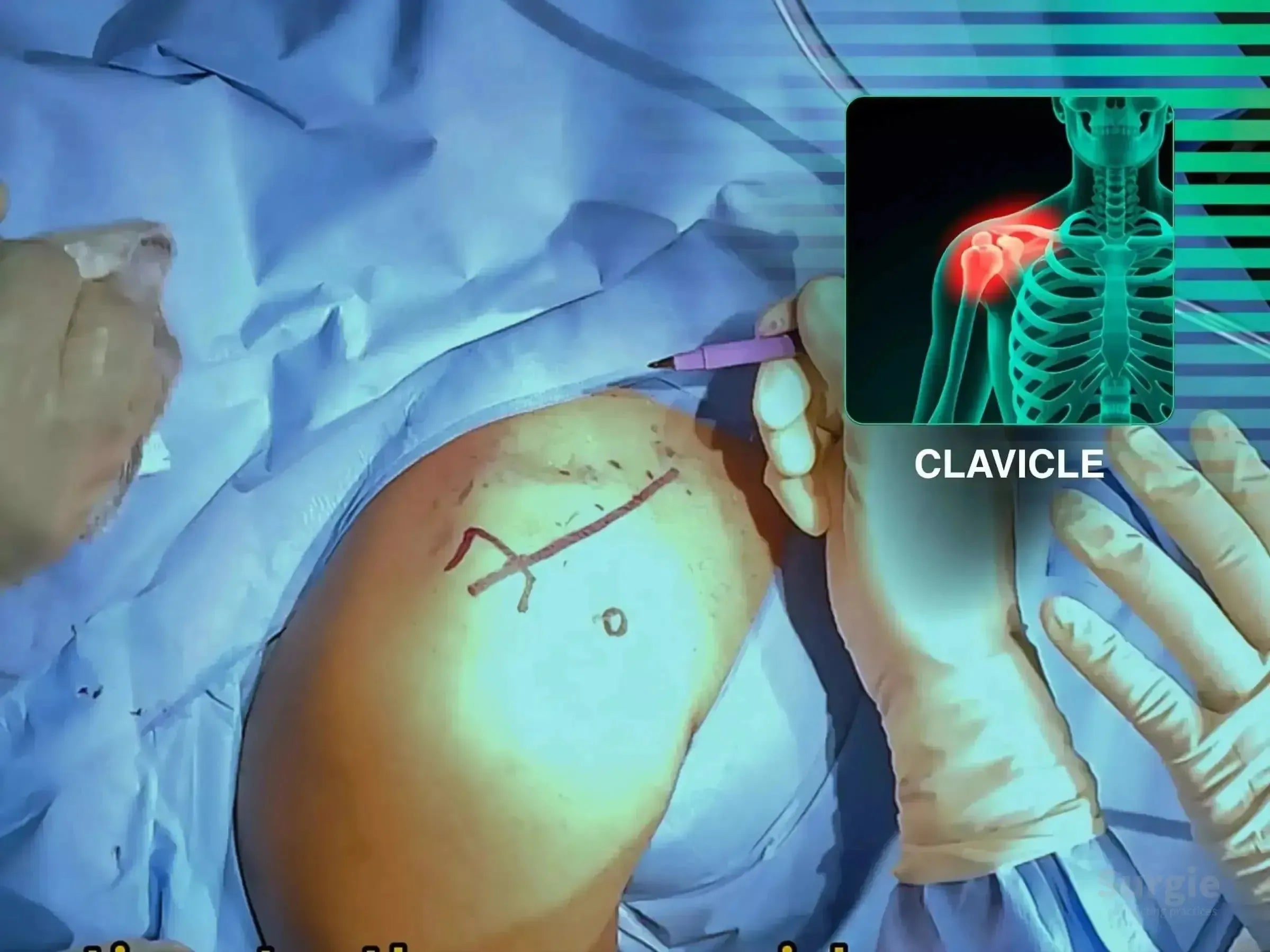 Surgeon marking a patient's shoulder for clavicle surgery with an anatomical overlay of a fractured collarbone.